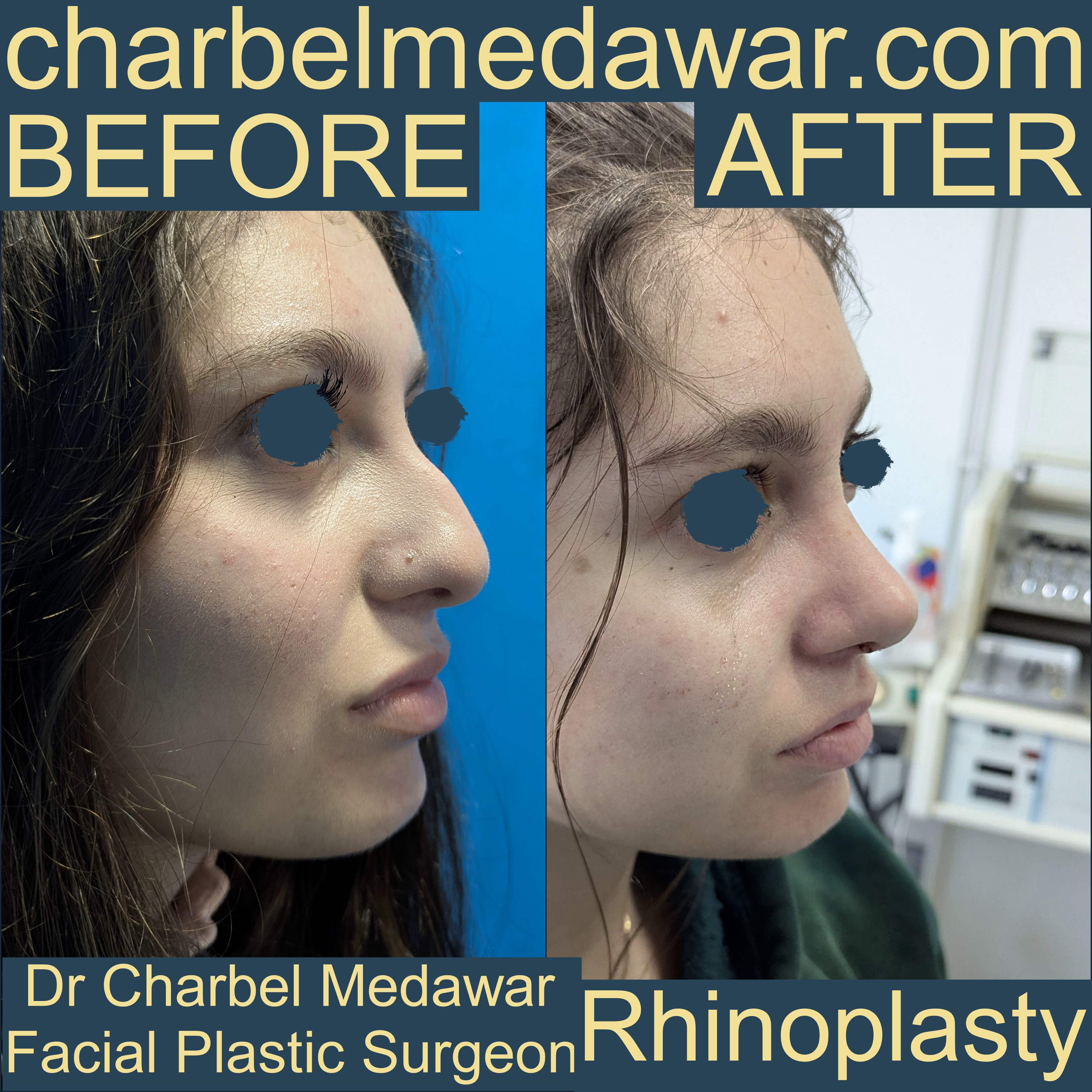 nose plastic surgery charbel medawar
