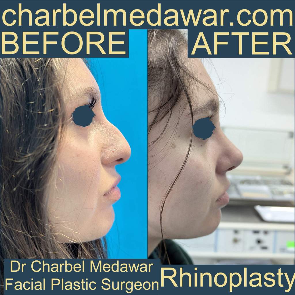 nose plastic surgery expert charbel medawar