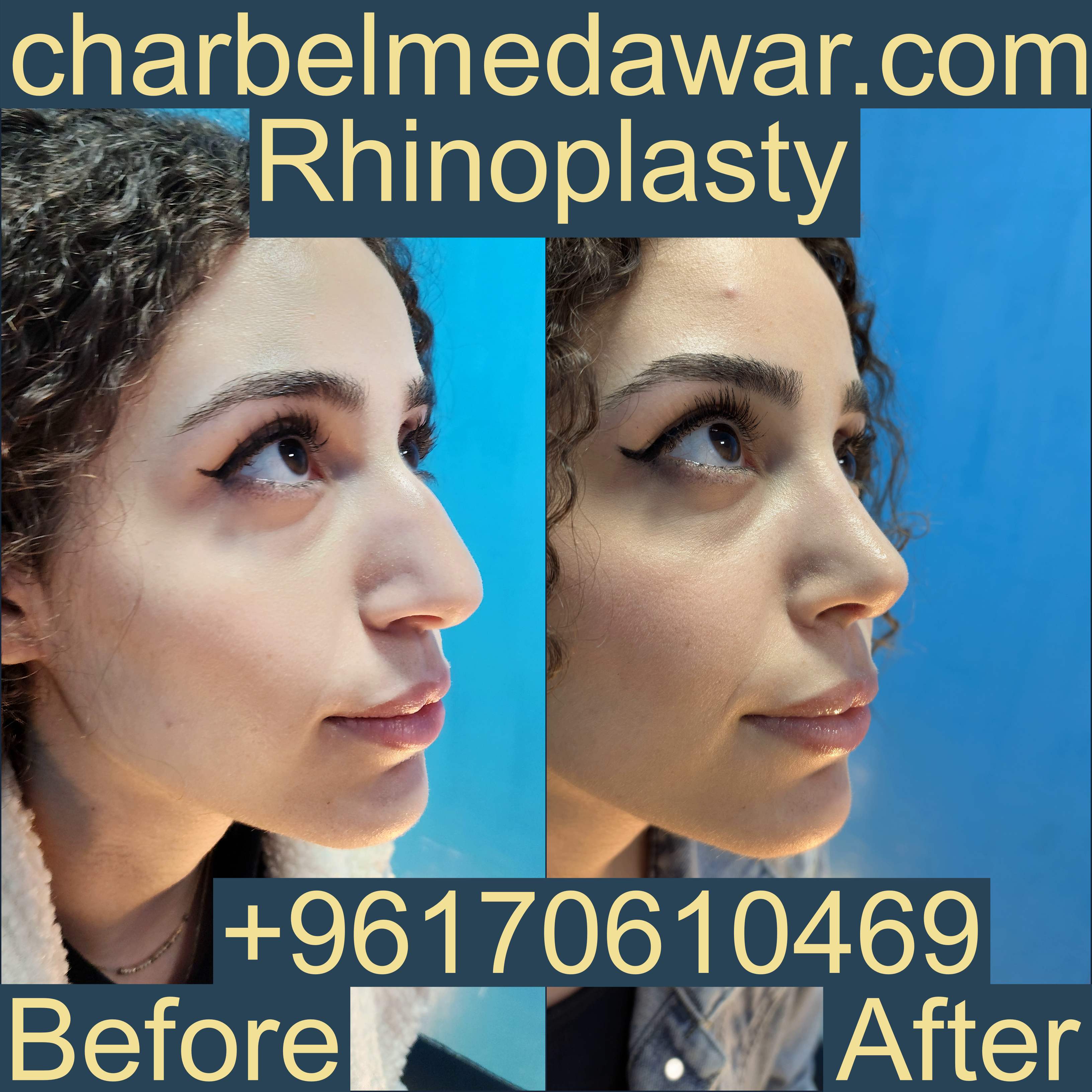 rhinoplasty before after doctor charbel medawar