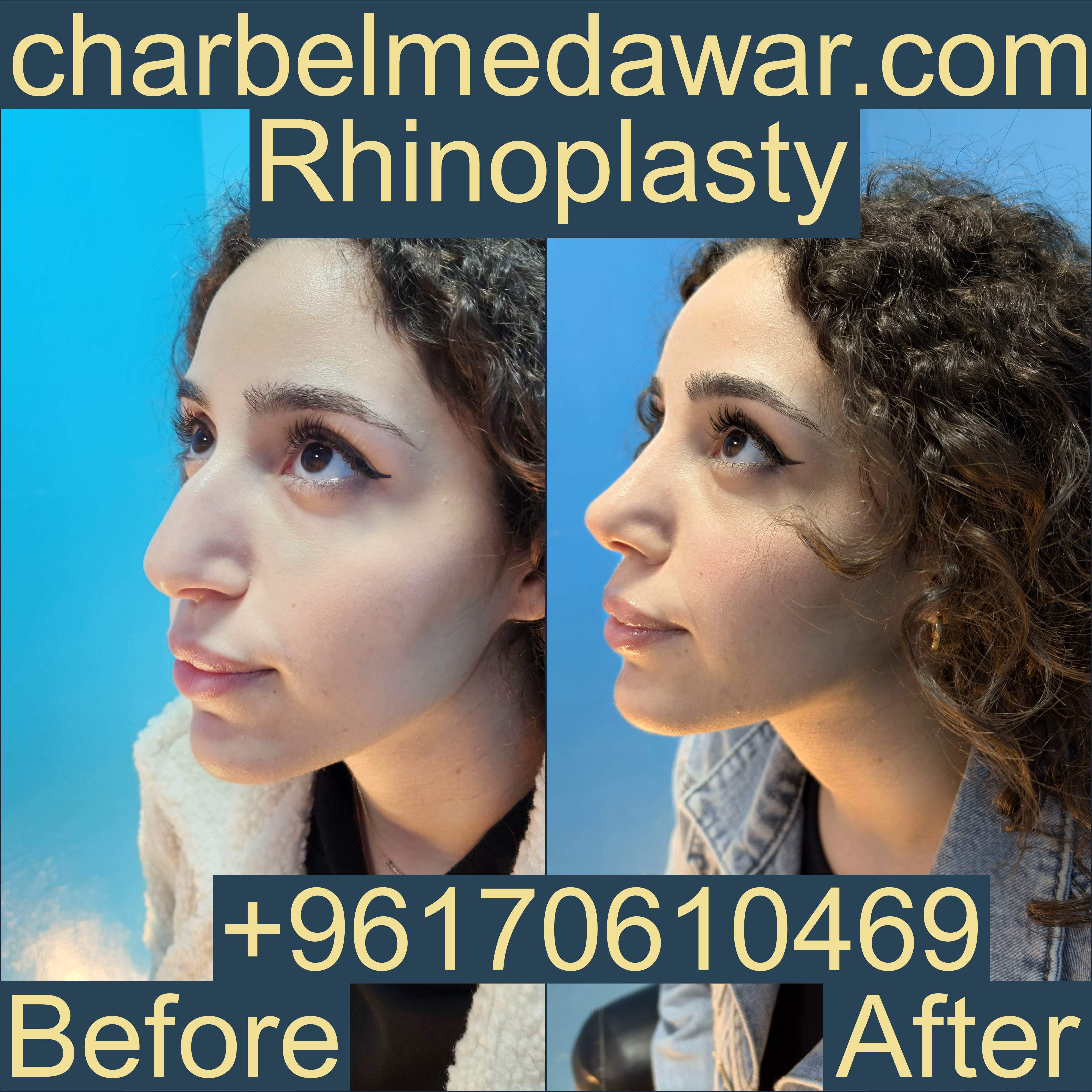 rhinoplasty before after dr charbel medawar