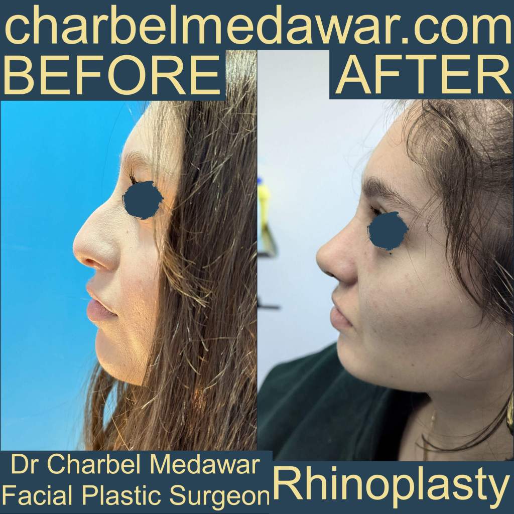 rhinoplasty expert charbel medawar