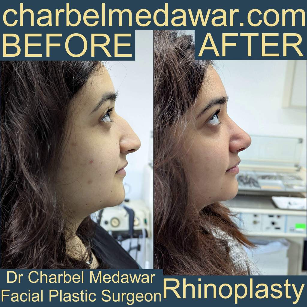 rhinoplasty expert doctor charbel medawar