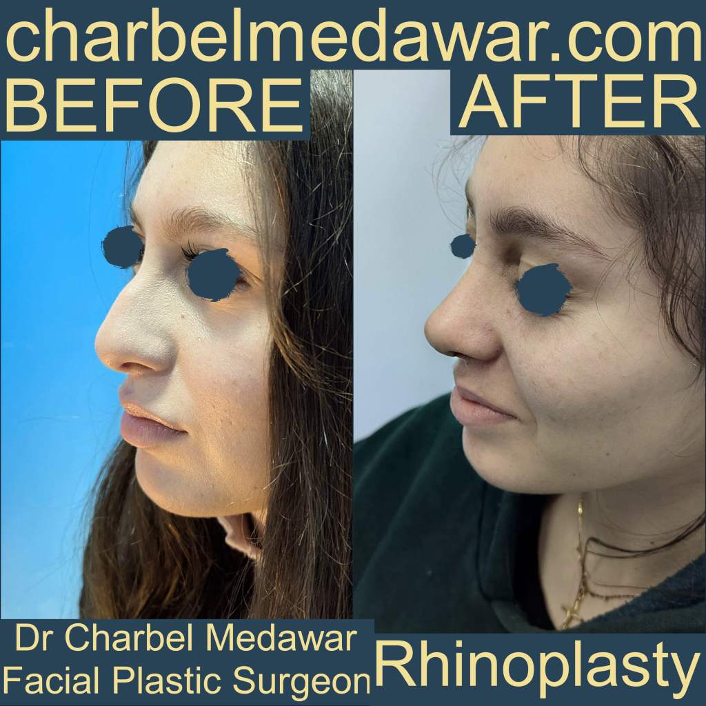 rhinoplasty specialist charbel medawar