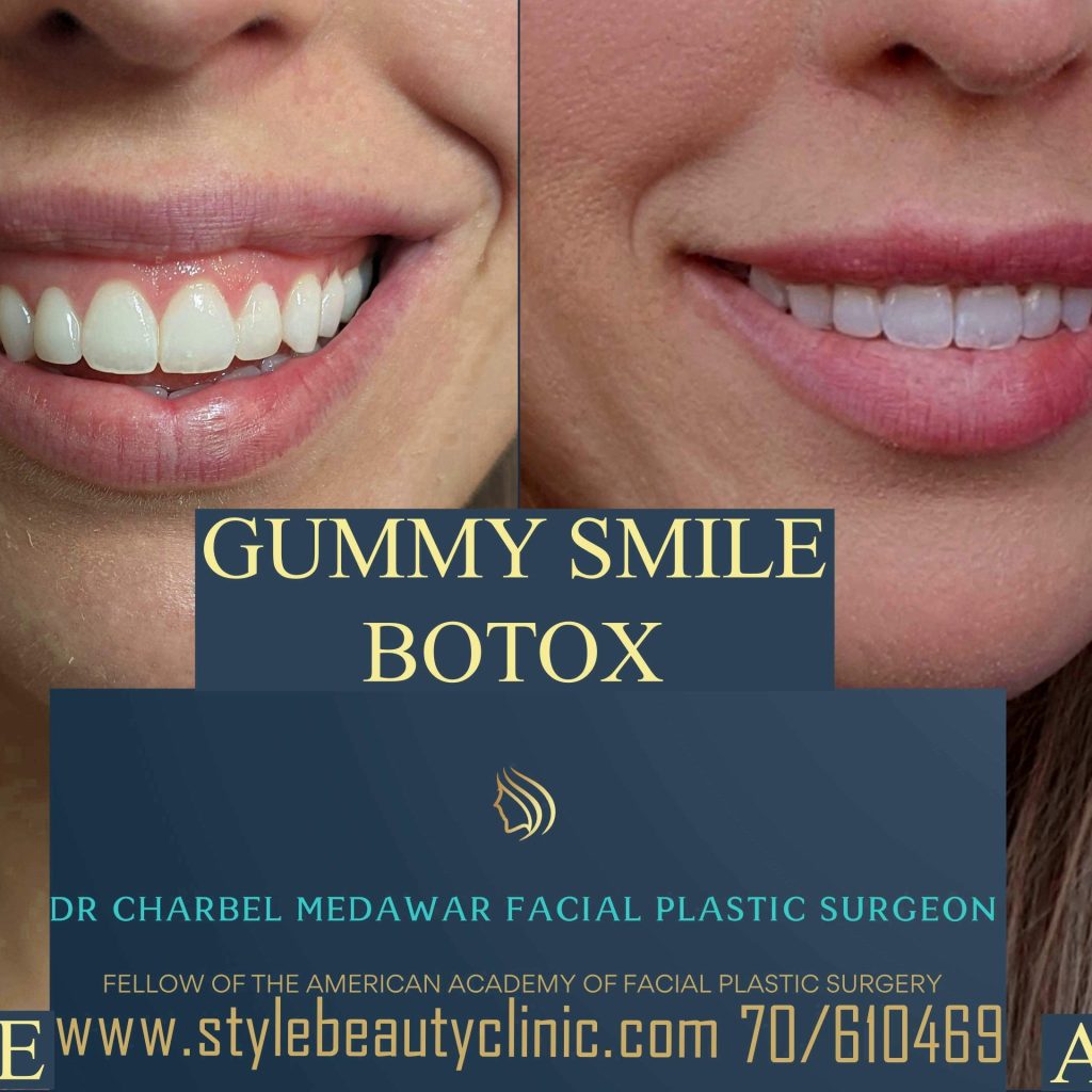 dr charbel medawar gummy smile botox
