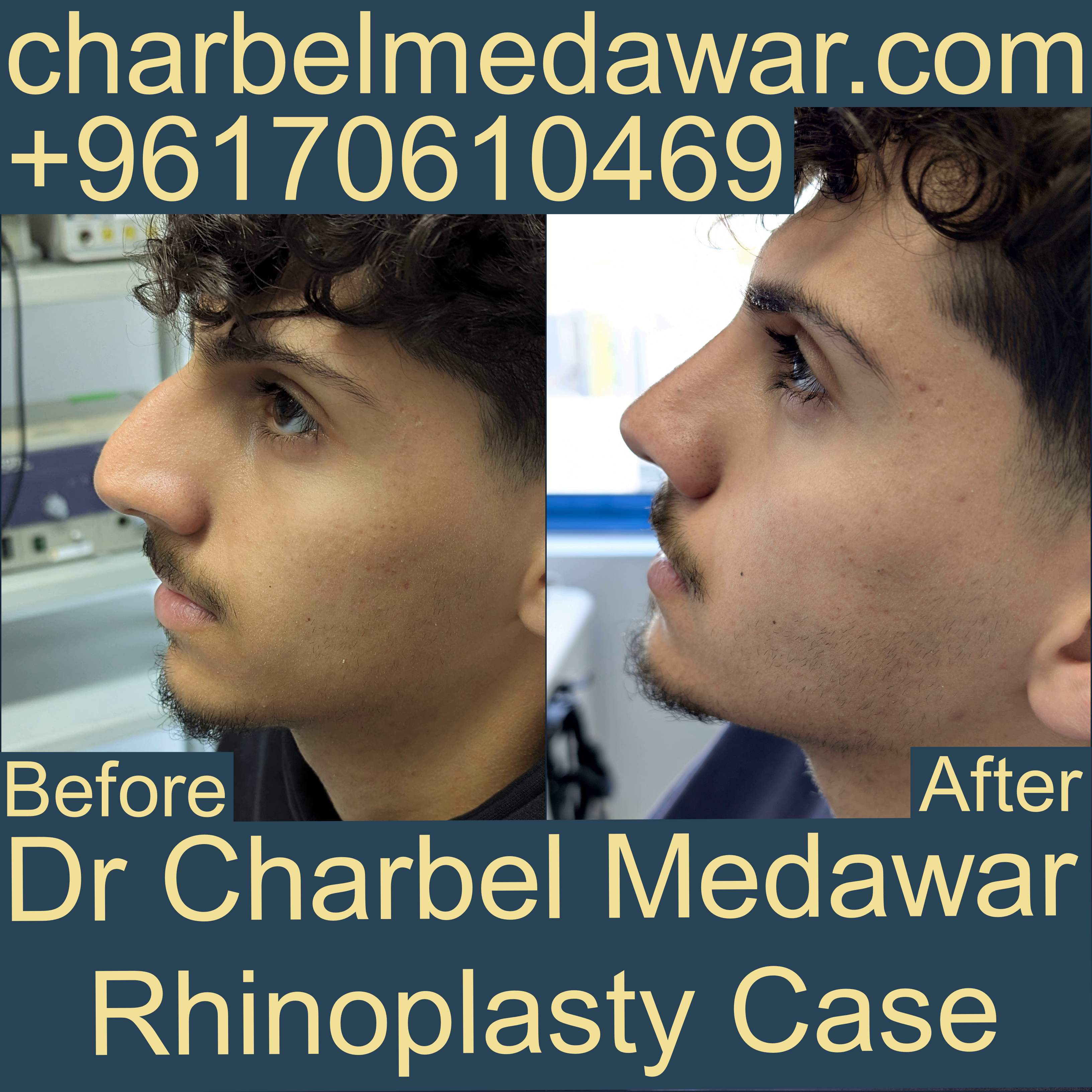 best plastic surgeon in lebanon dr charbel medawar