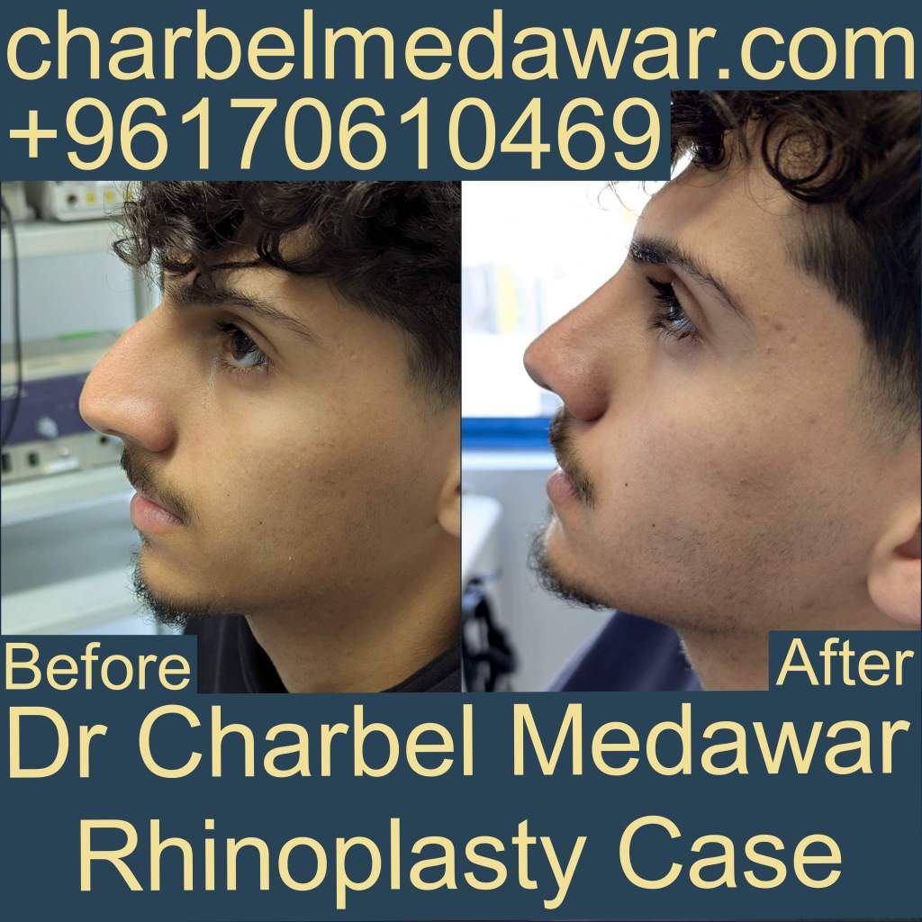 best plastic surgeon in lebanon dr charbel medawar