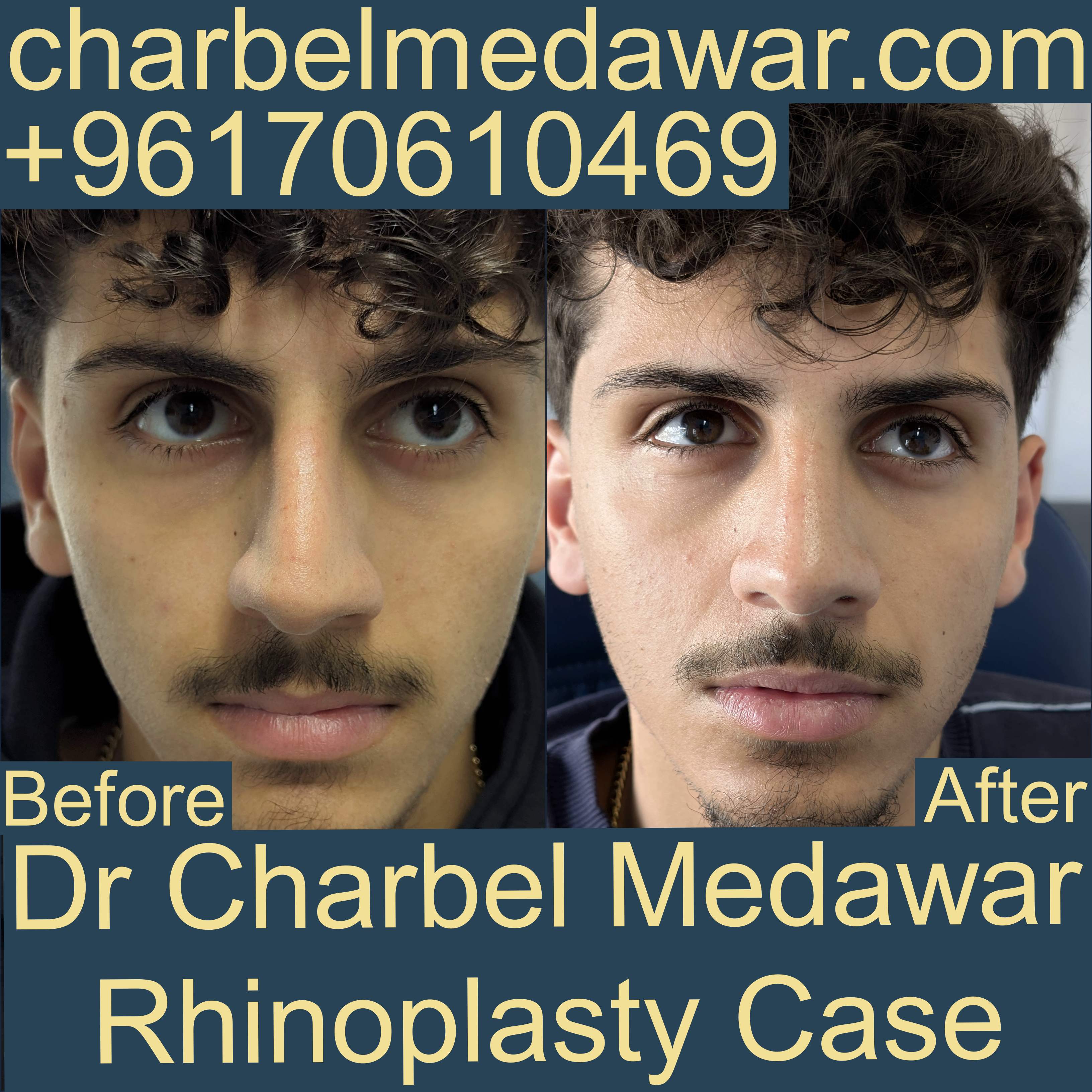 best plastic surgeon lebanon charbel medawar