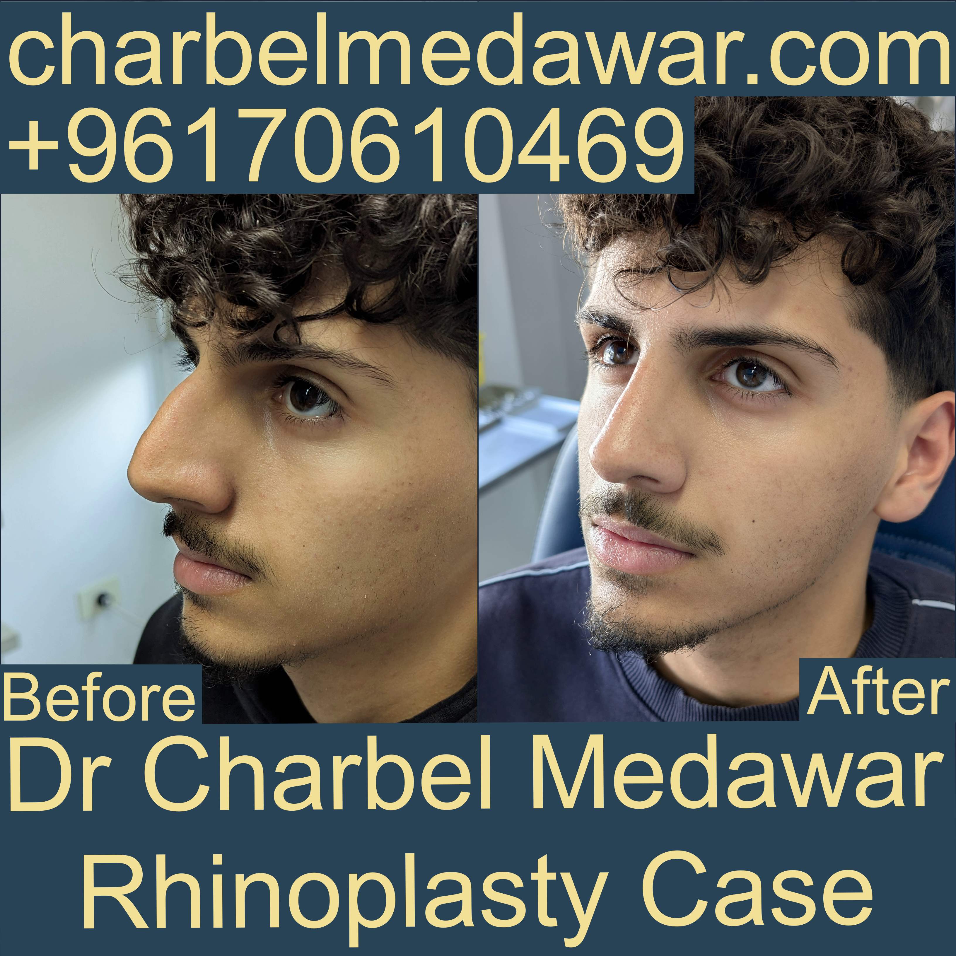 best plastic surgeon lebanon dr charbel medawar