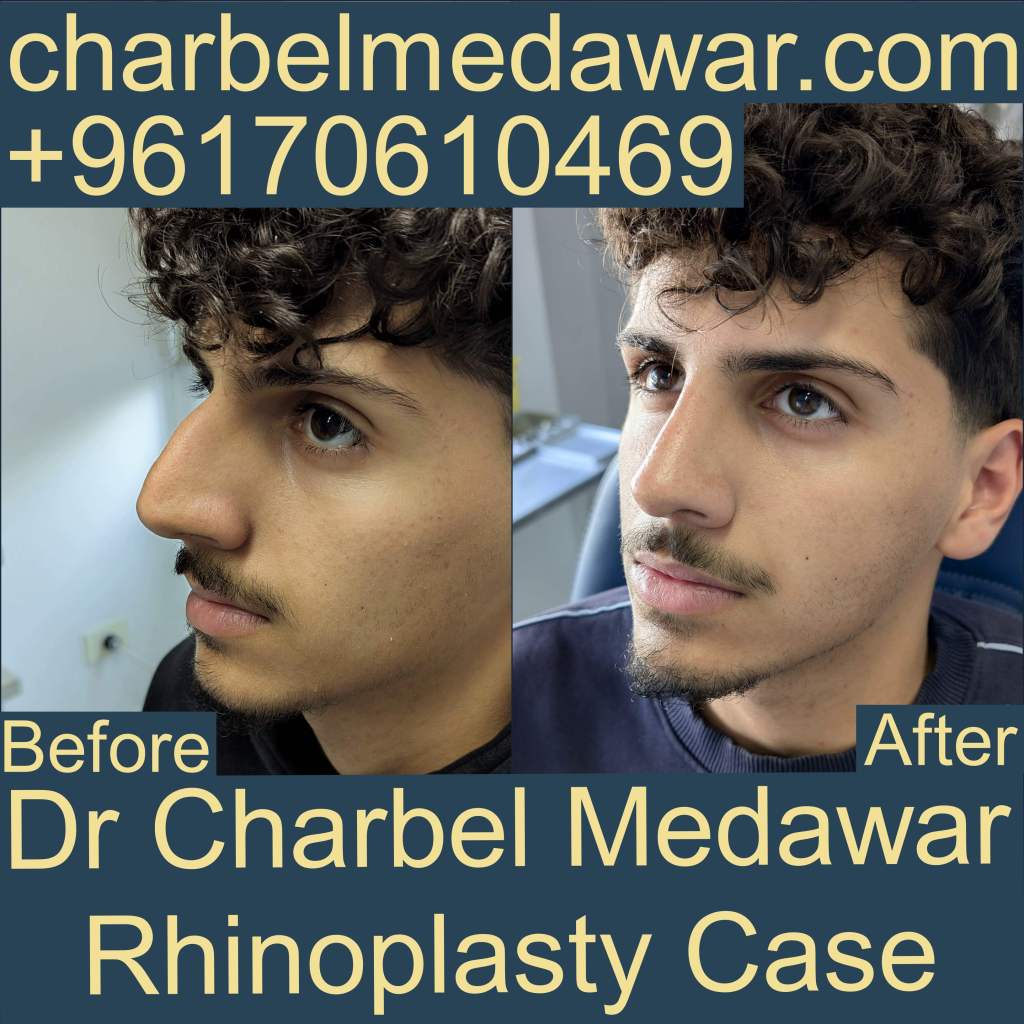 best plastic surgeon lebanon dr charbel medawar