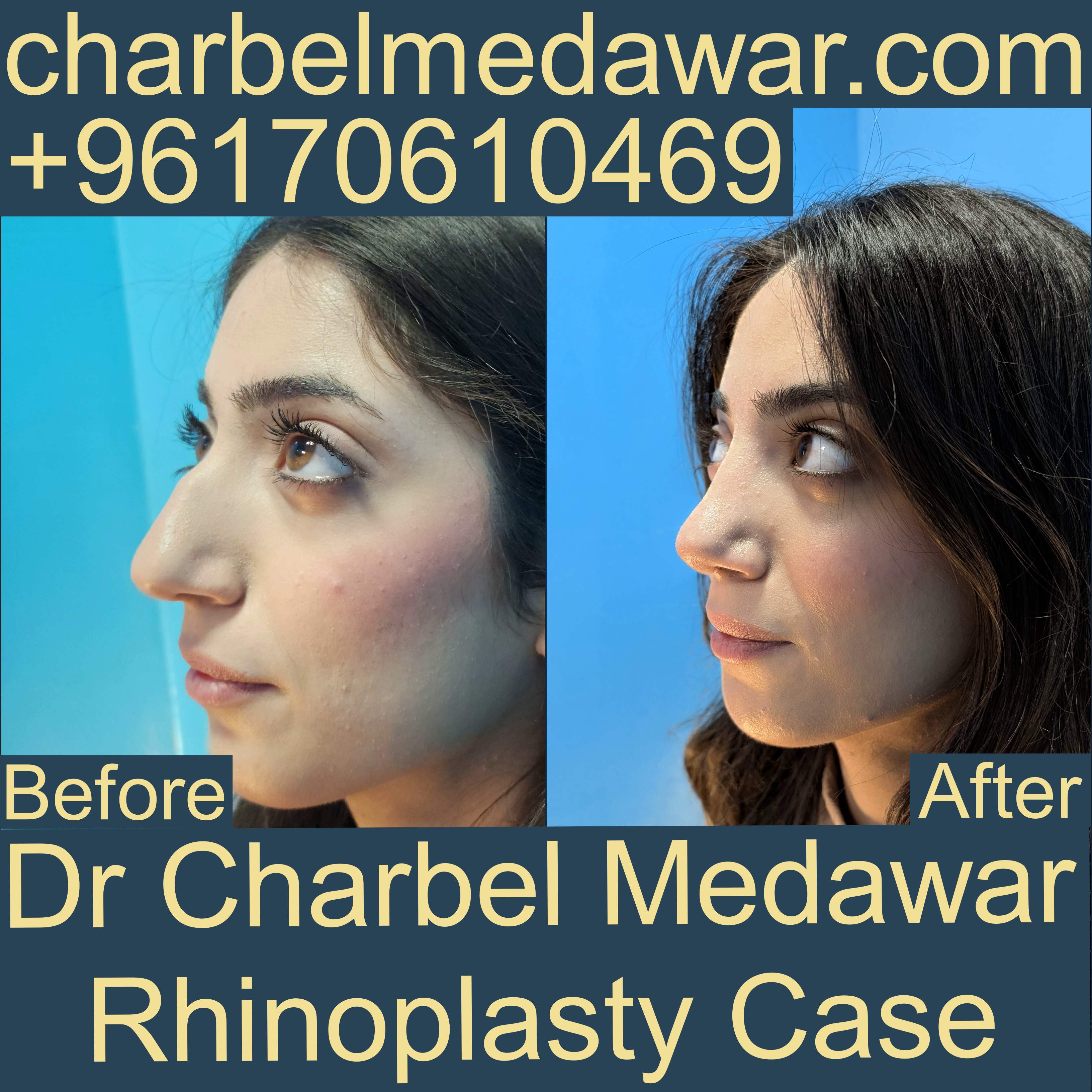 natural rhinoplasty results dr charbel medawar lebanon