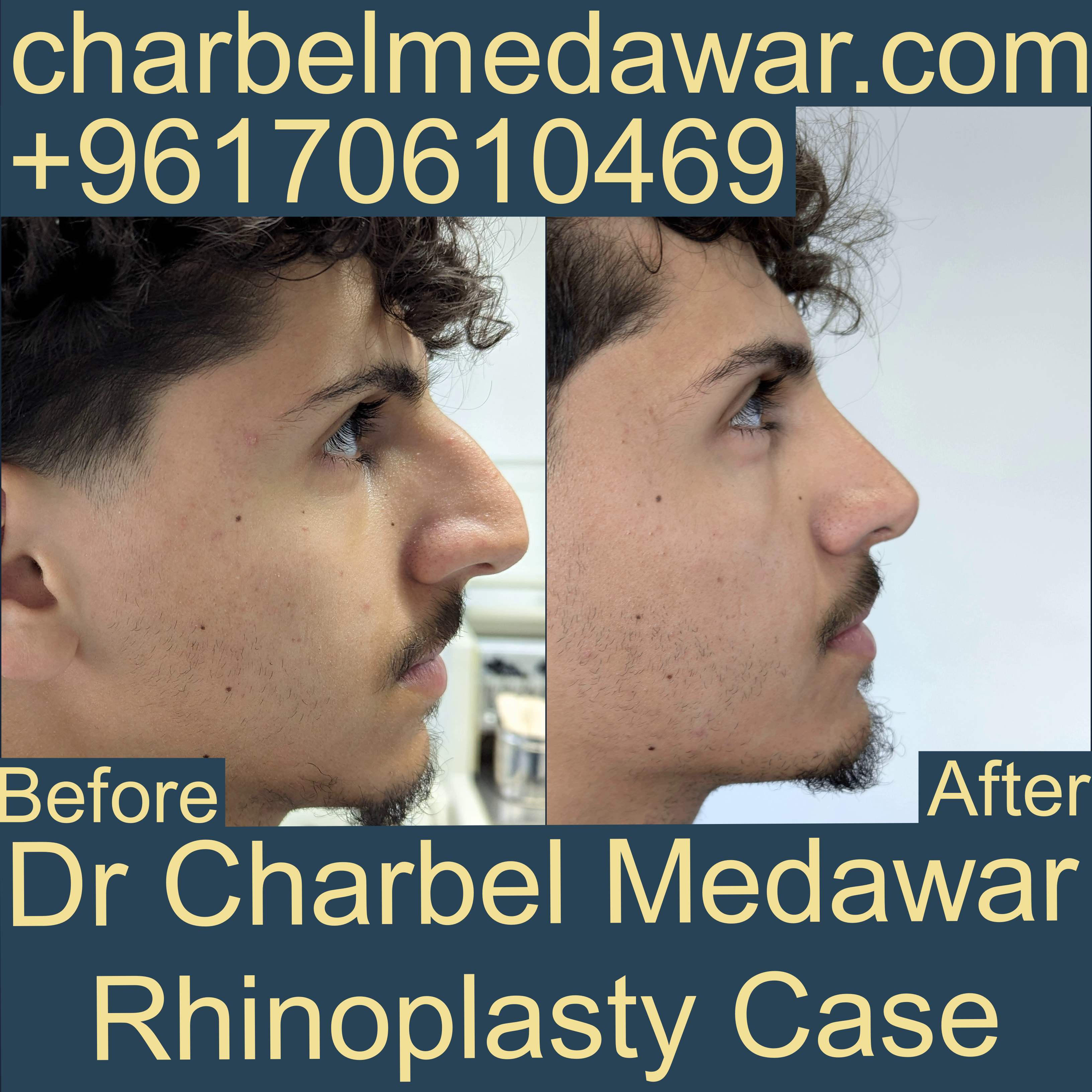 plastic surgeon lebanon dr charbel medawar