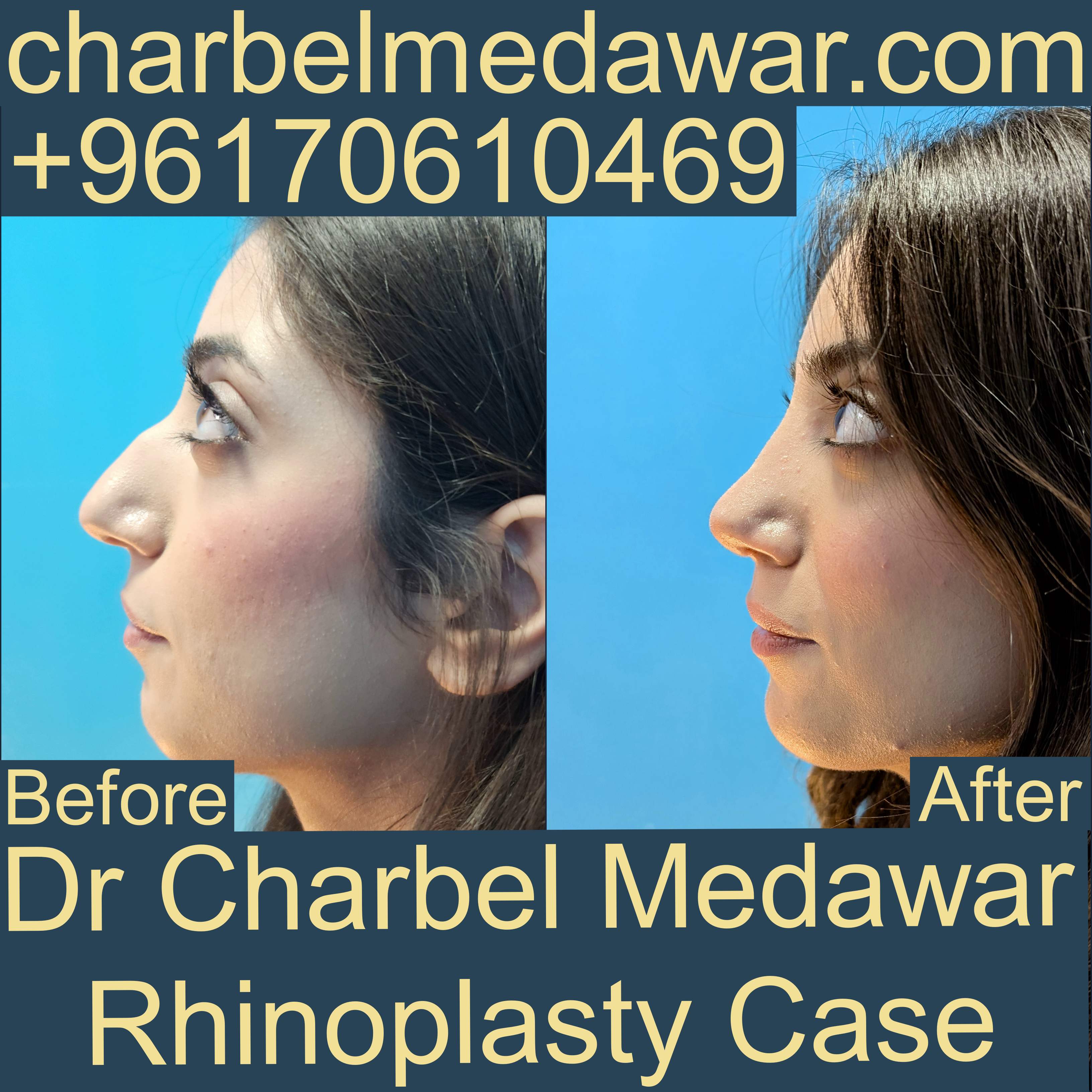 safest plastic surgery in lebanon dr charbel medawar
