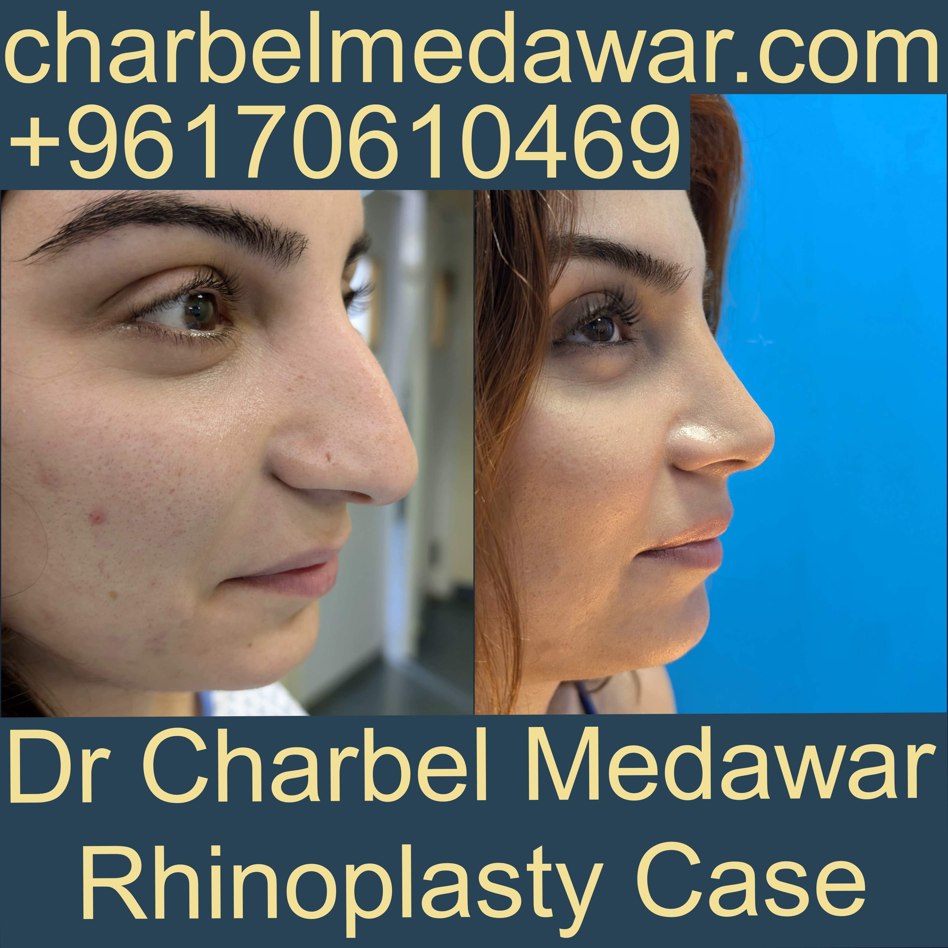top plastic surgeon in lebanon dr charbel medawar