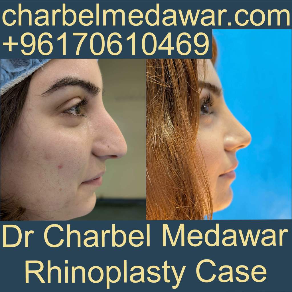 top plastic surgeon lebanon charbel medawar