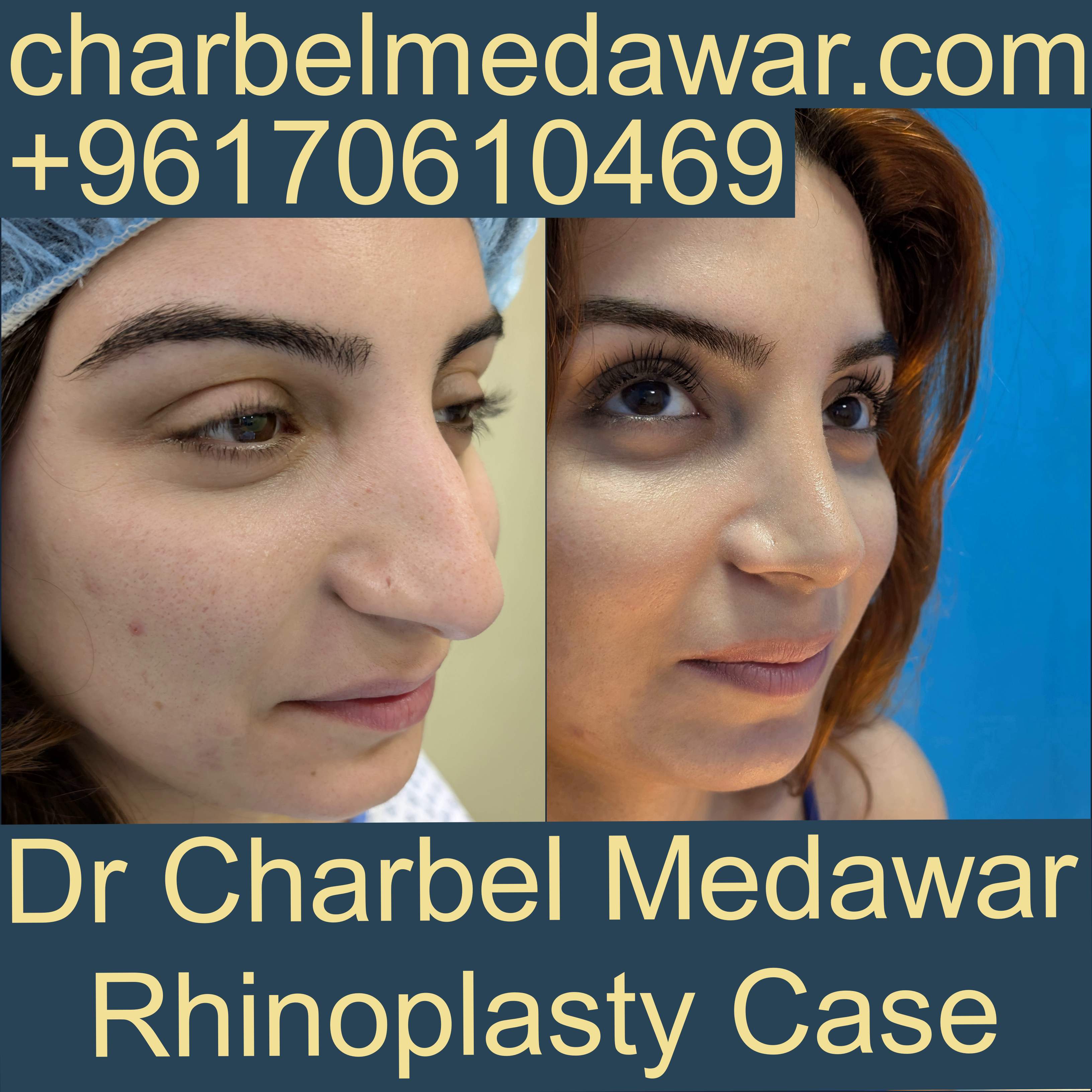top plastic surgeon lebanon dr charbel medawar