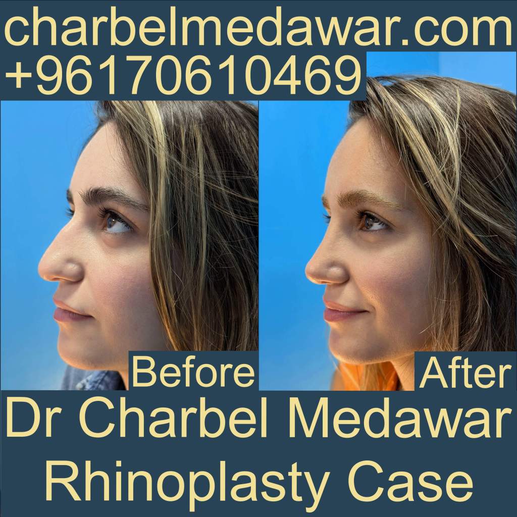 best natural nose plastic surgery in lebanon dr charbel medawar