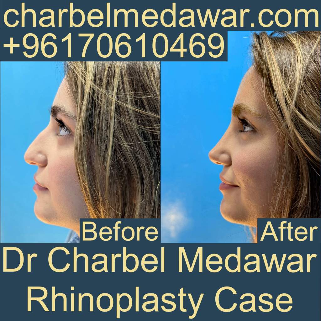 best natural nosejob in lebanon dr charbel medawar