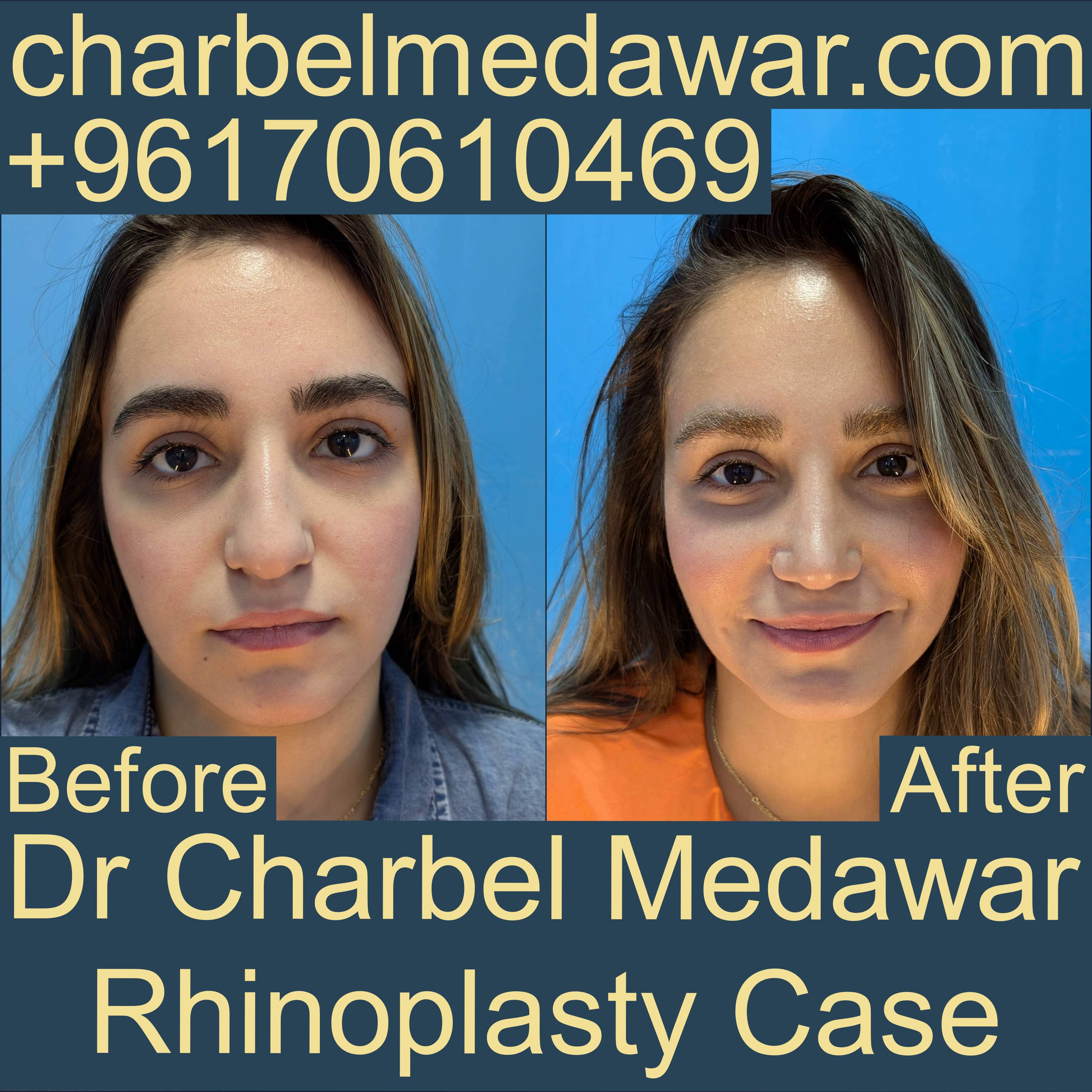 best natural rhinoplasty in lebanon dr charbel medawar