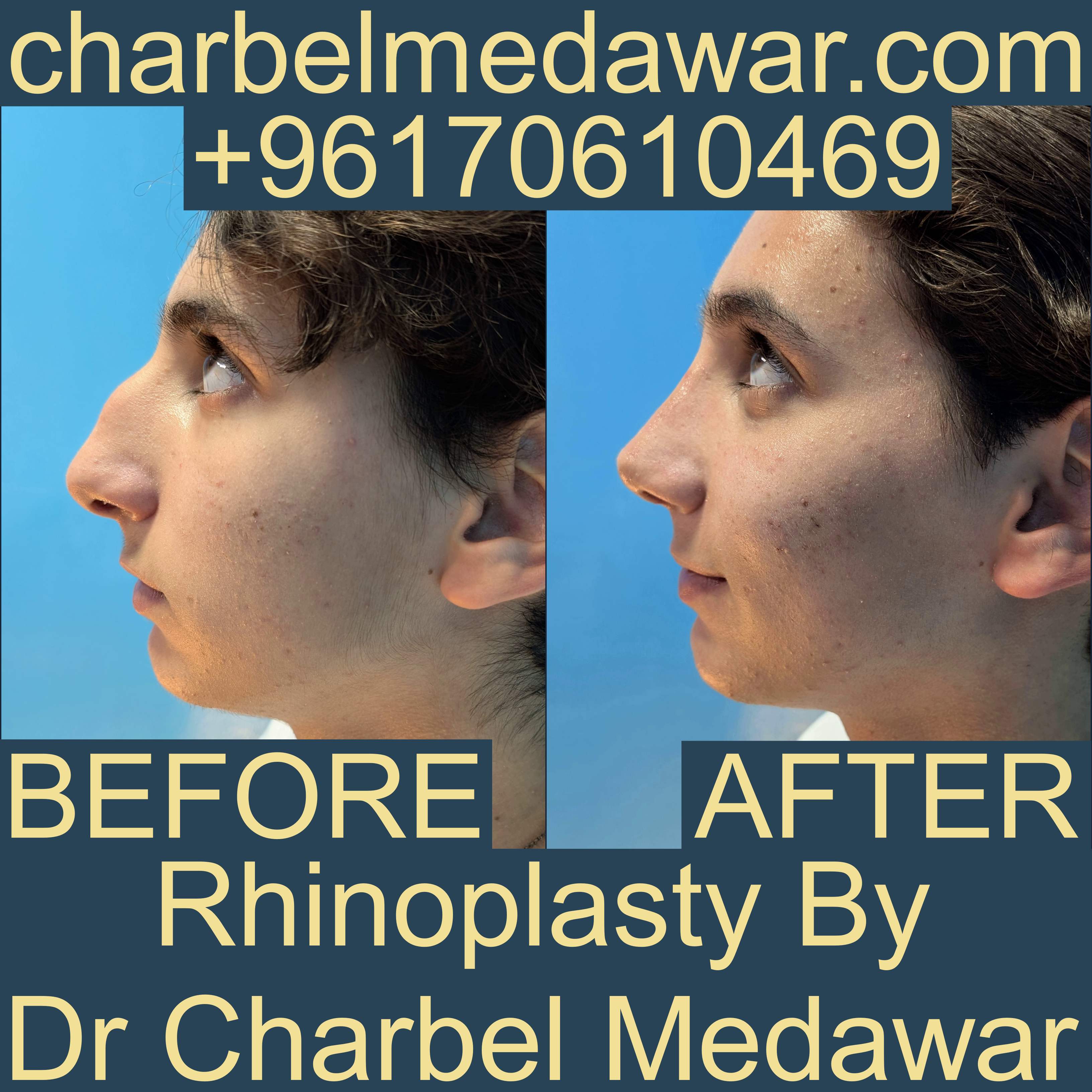 أفضل جراح تجميل الأنف في بيروت لبنان