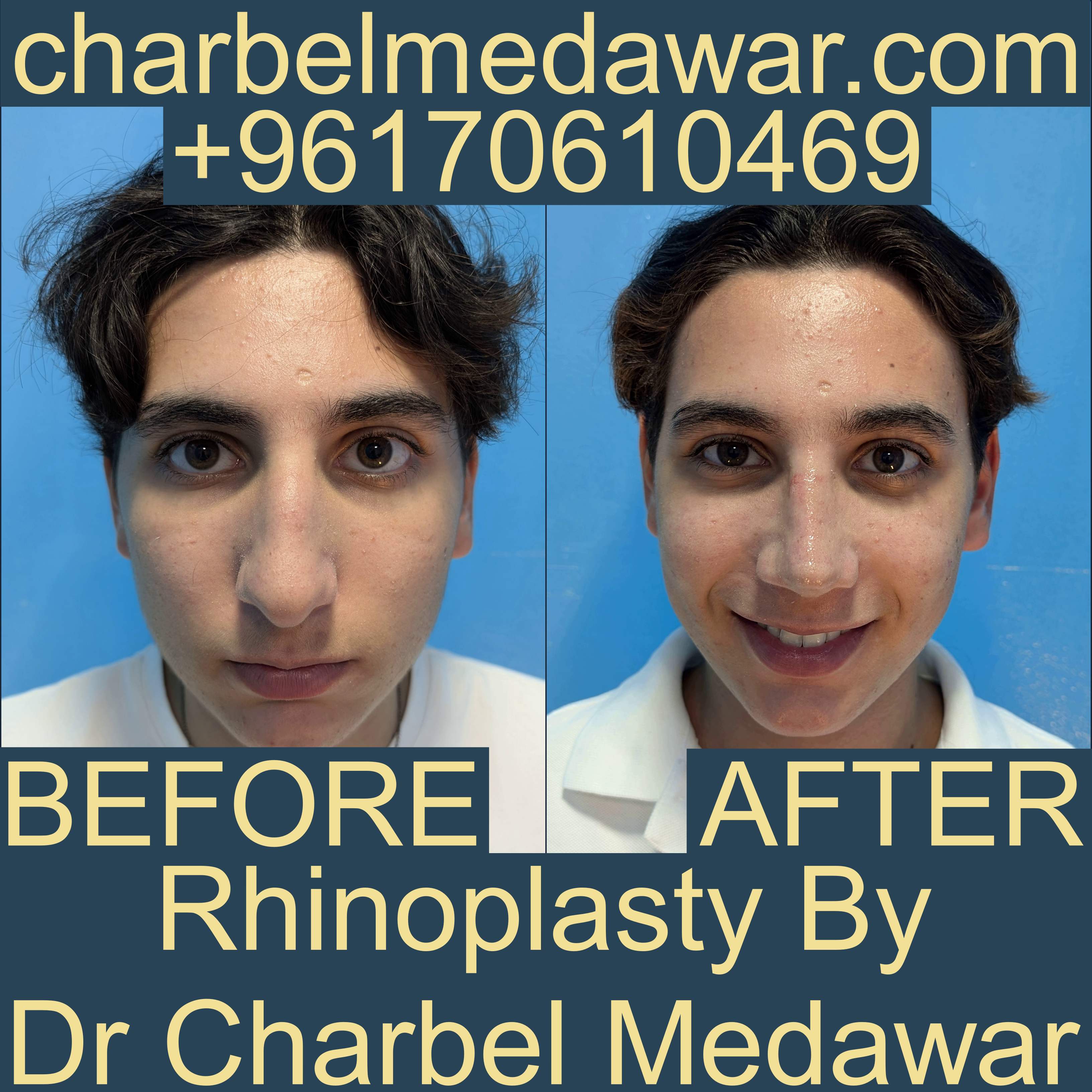 أفضل جراح تجميل الأنف في لبنان