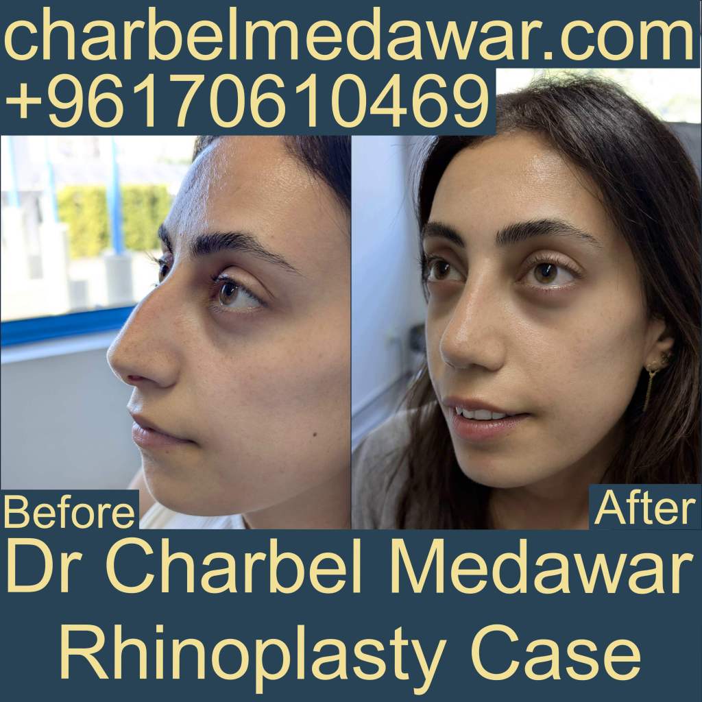 natural rhinoplasty nose plastic surgery charbel medawar lebanon