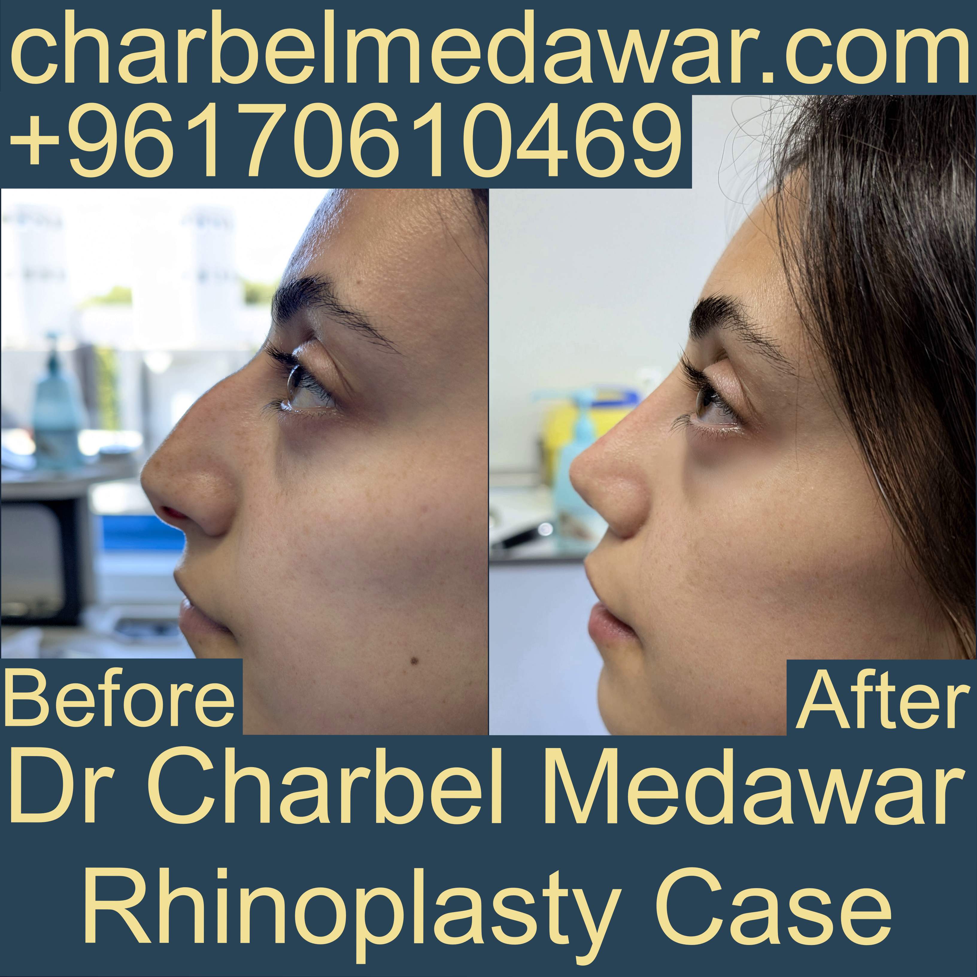 top natural nose plastic surgery in lebanon dr charbel medawar