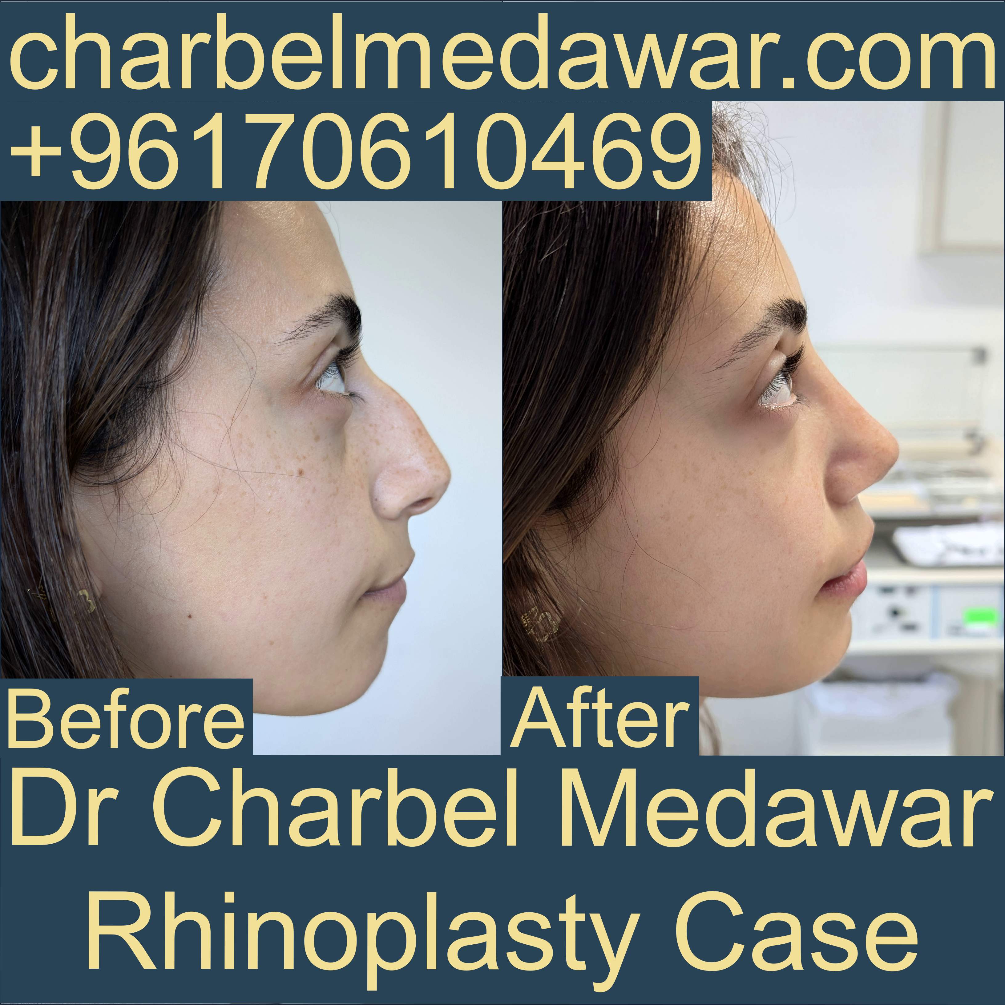 top natural nosejob in lebanon dr charbel medawar