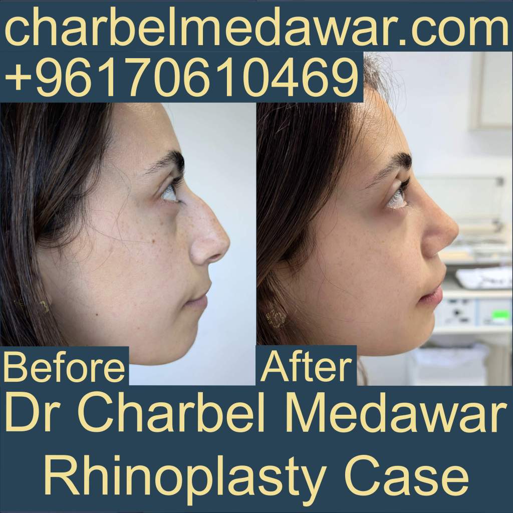 top natural nosejob in lebanon dr charbel medawar