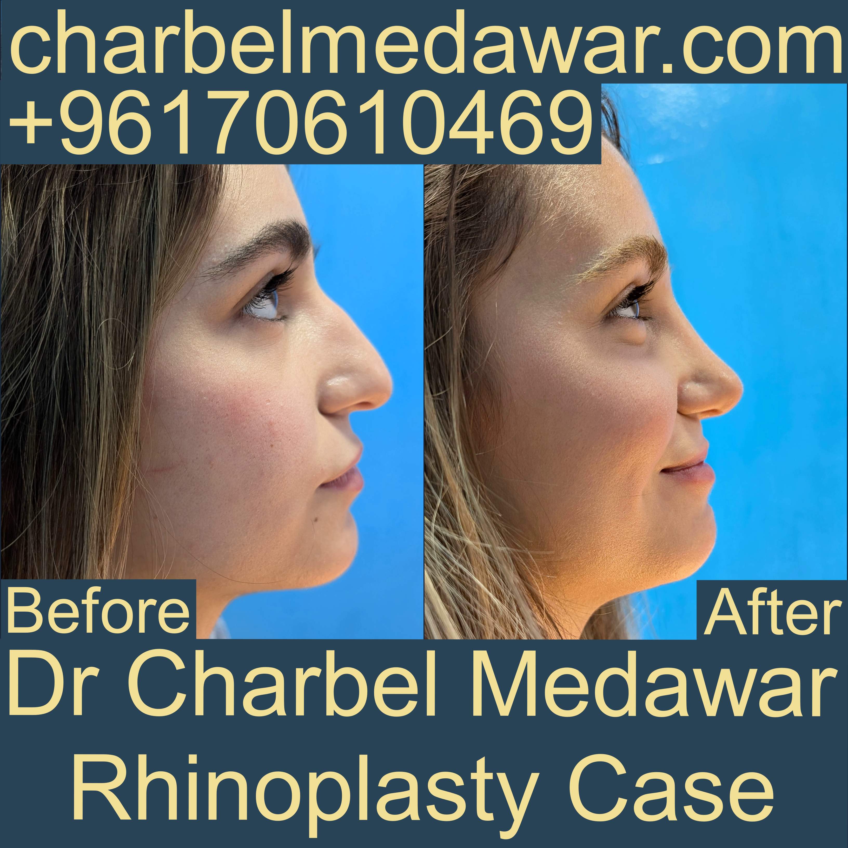 top natural rhinoplasty in lebanon dr charbel medawar