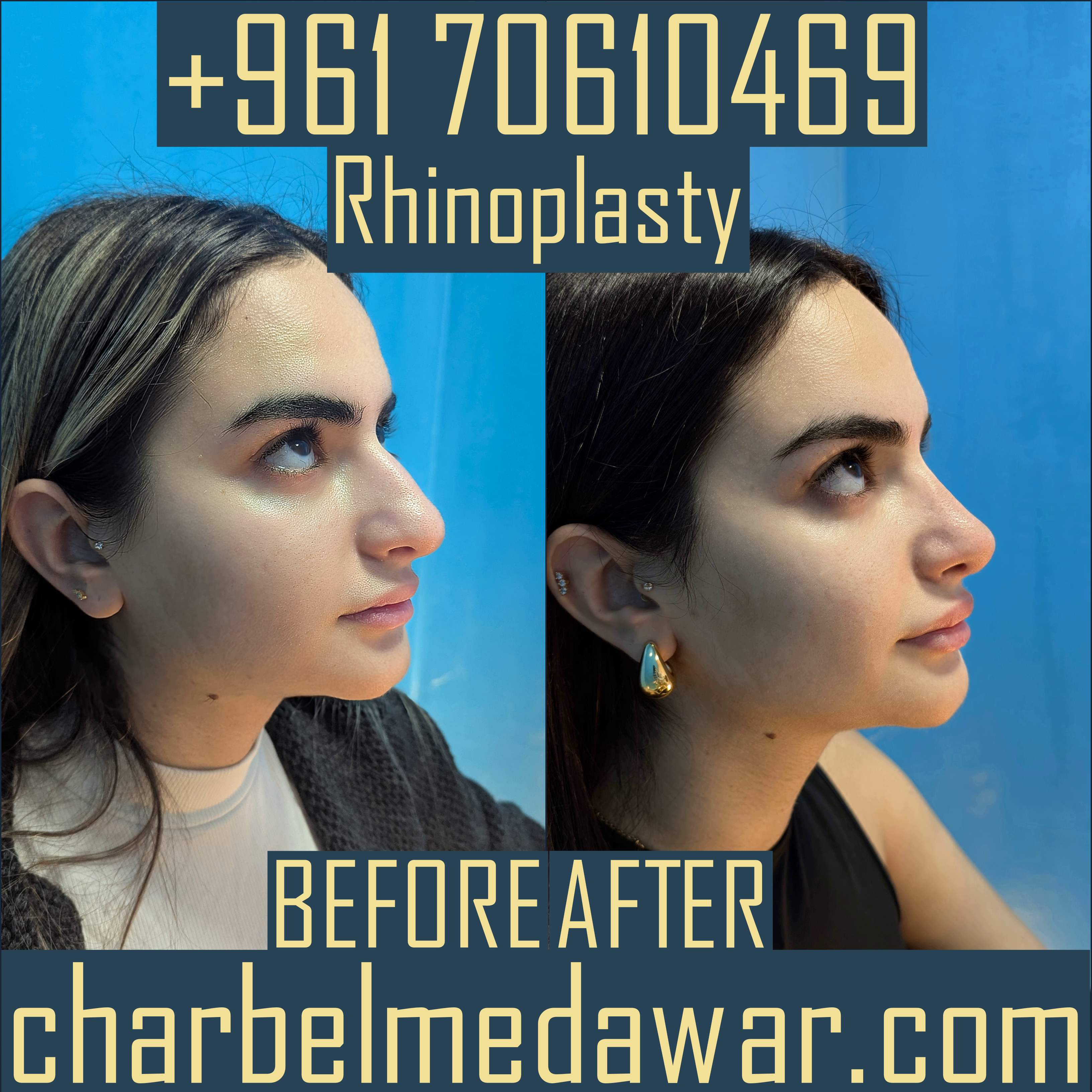 rhinoplasty lebanon expert dr charbel medawar