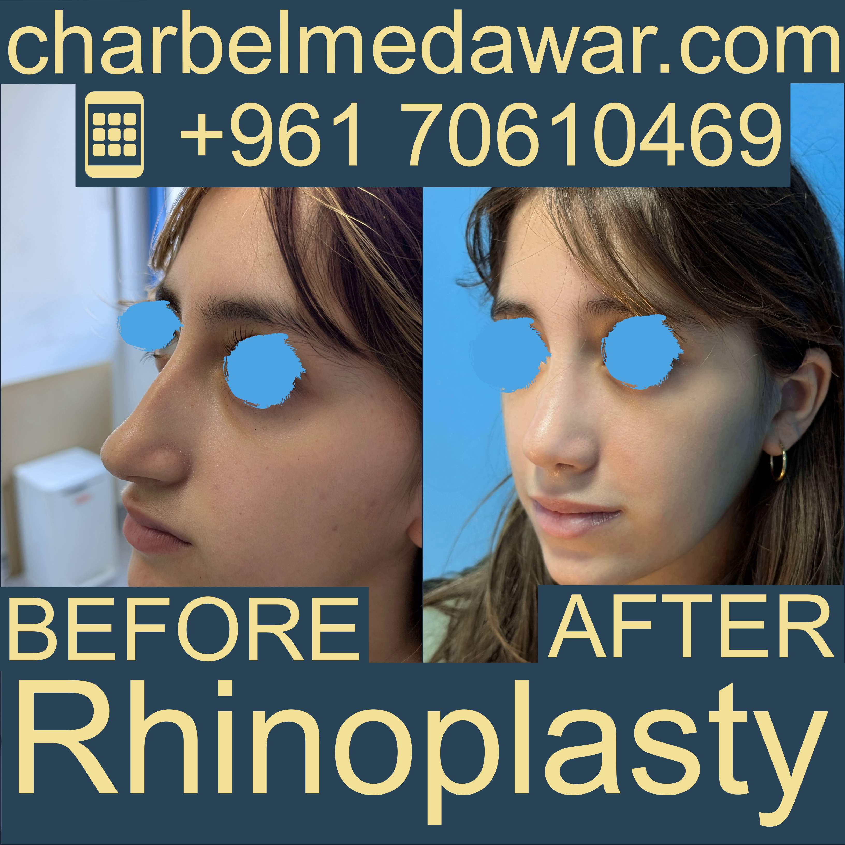 أفضل تقنيات تجميل الأنف في لبنان