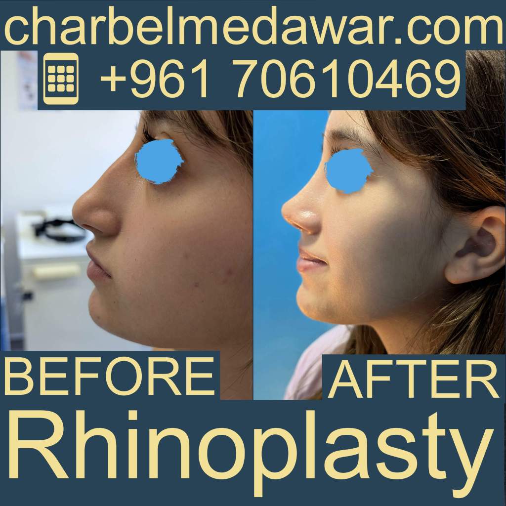 أفضل دكتور تجميل أنف في لبنان