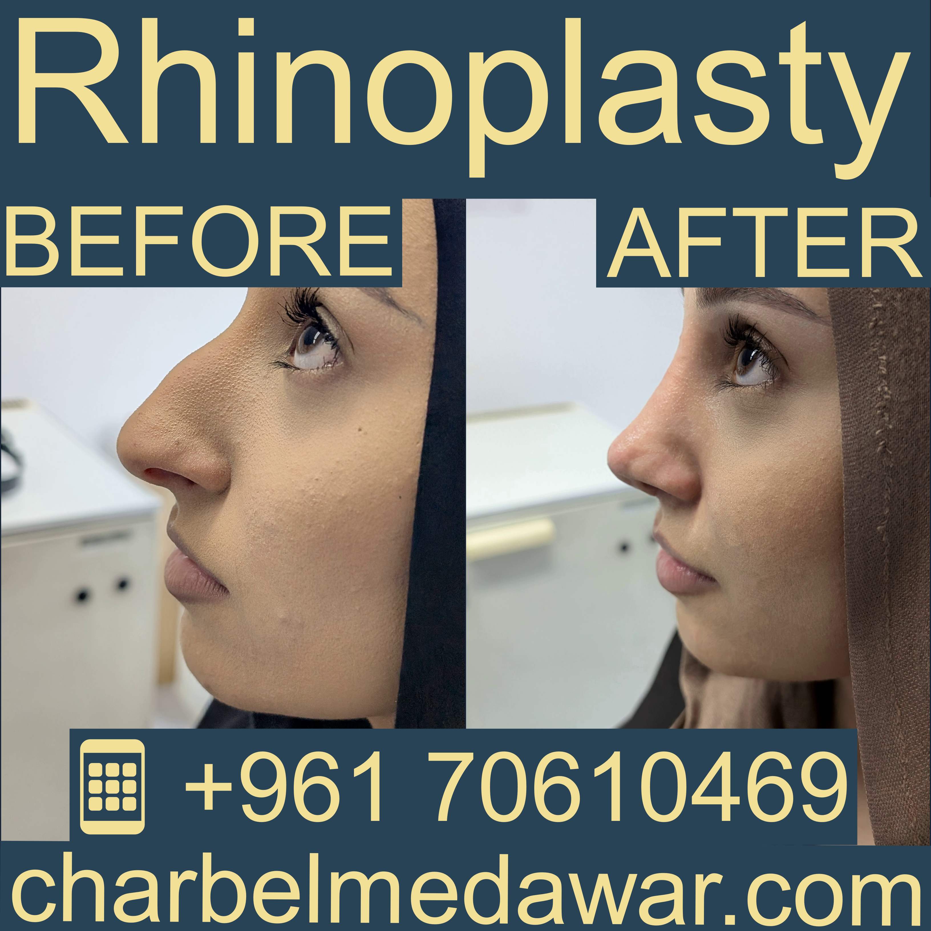أفضل طبيب تجميل أنف في الشرق الأوسط