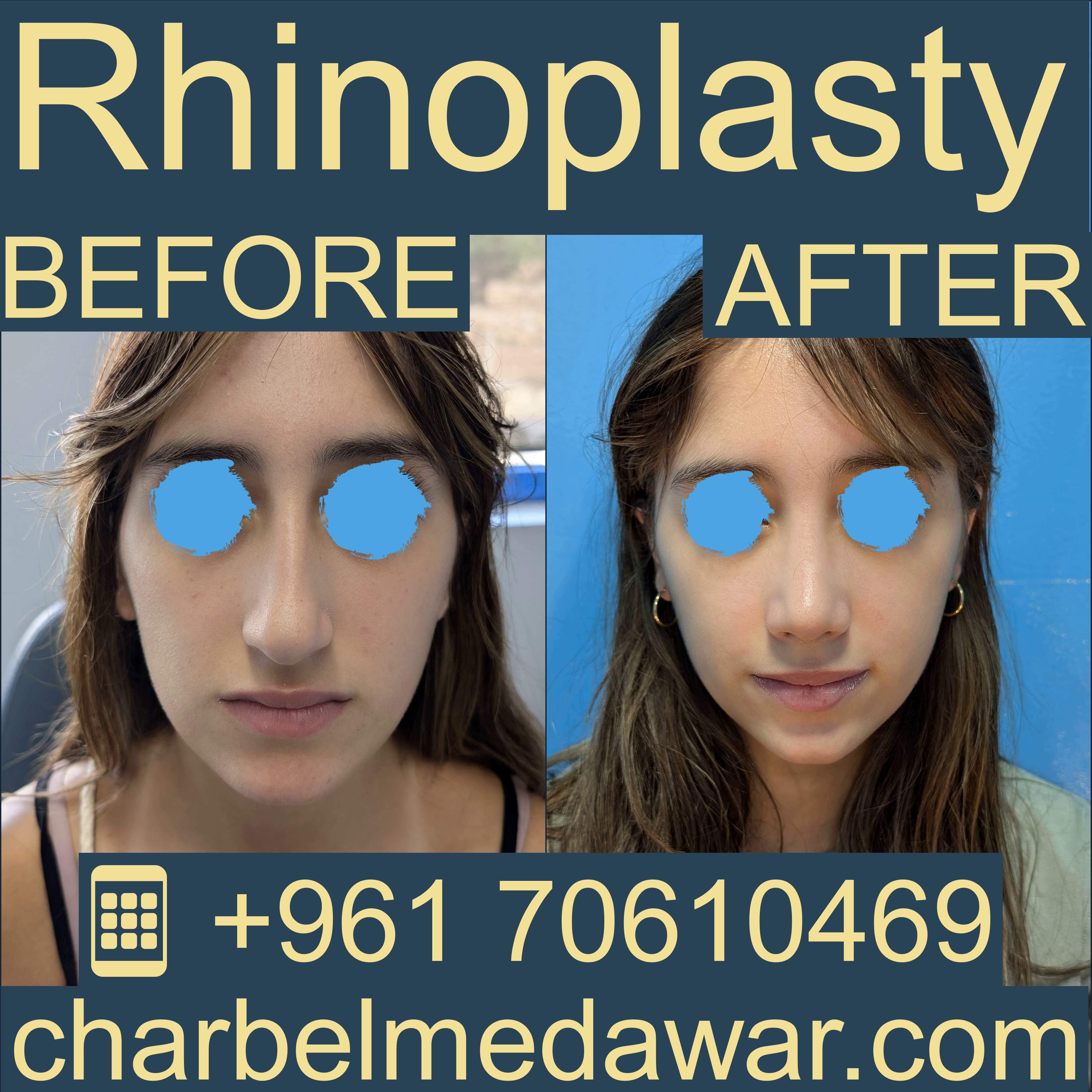 تجميل الأنف لبنان