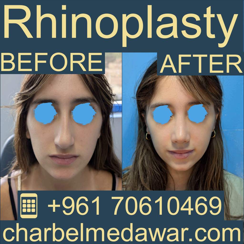تجميل الأنف لبنان