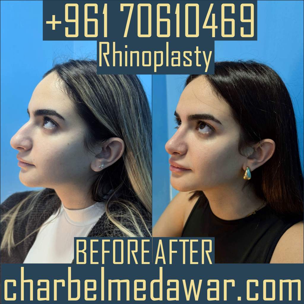 dr charbel medawar rhinoplasty expert lebanon