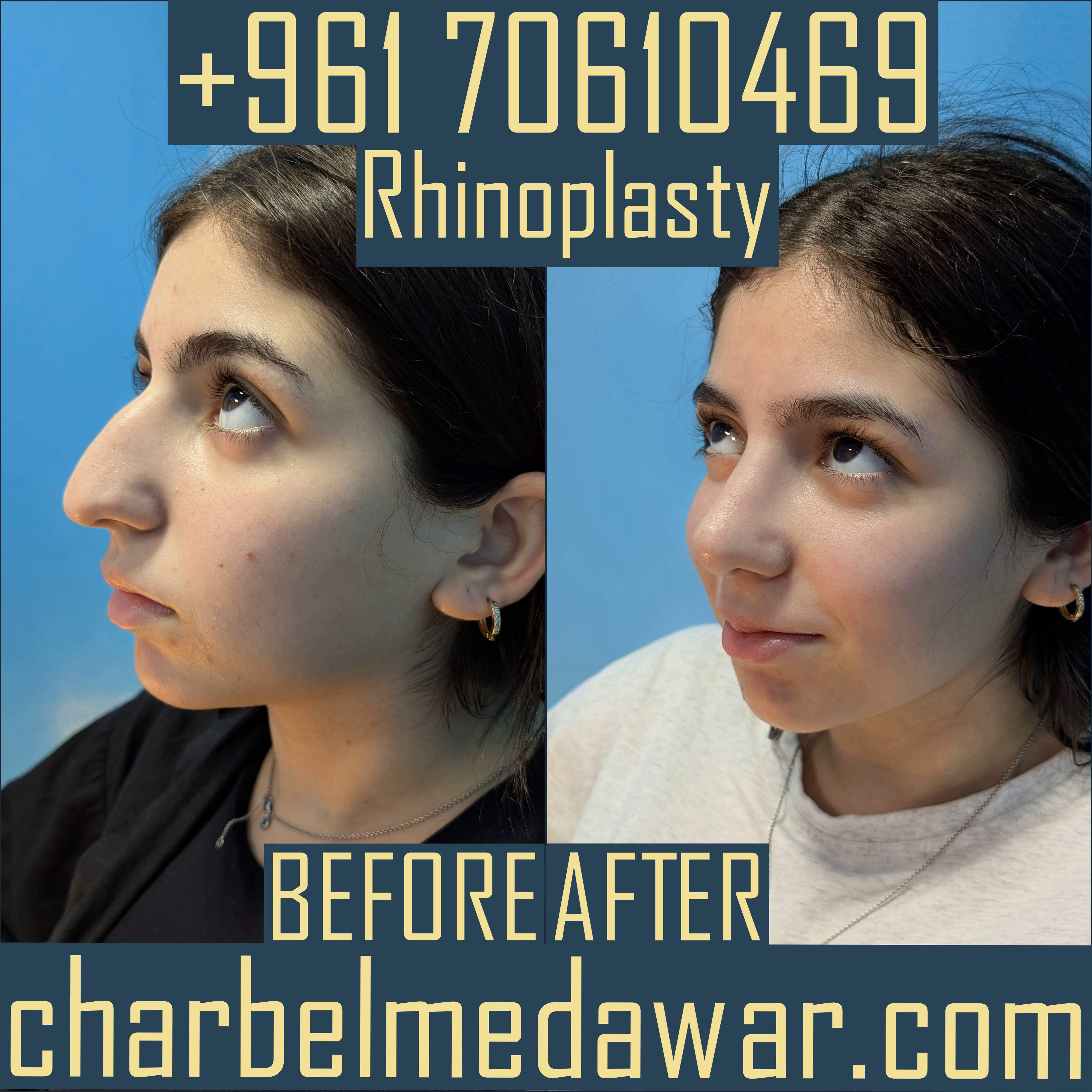 dr charbel medawar top rated rhinoplasty surgeon in lebanon