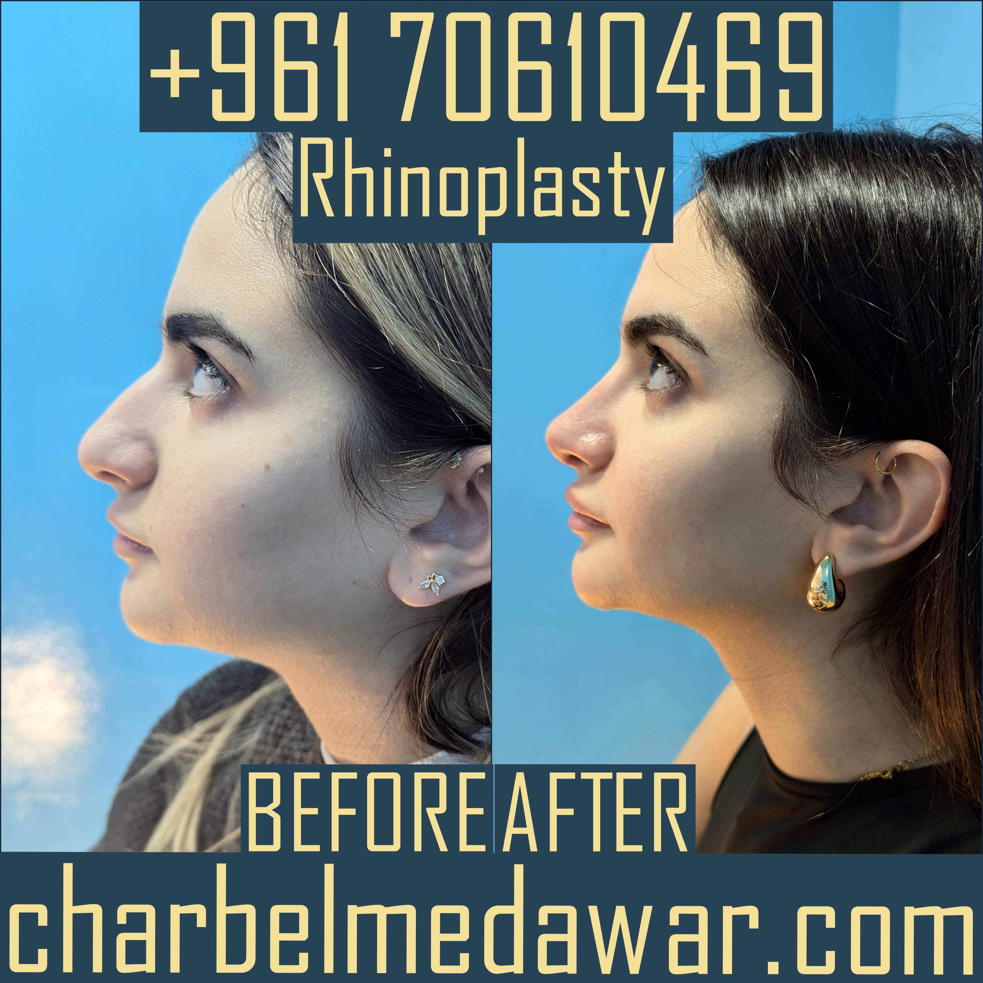 rhinoplasty expert lebanon dr charbel medawar