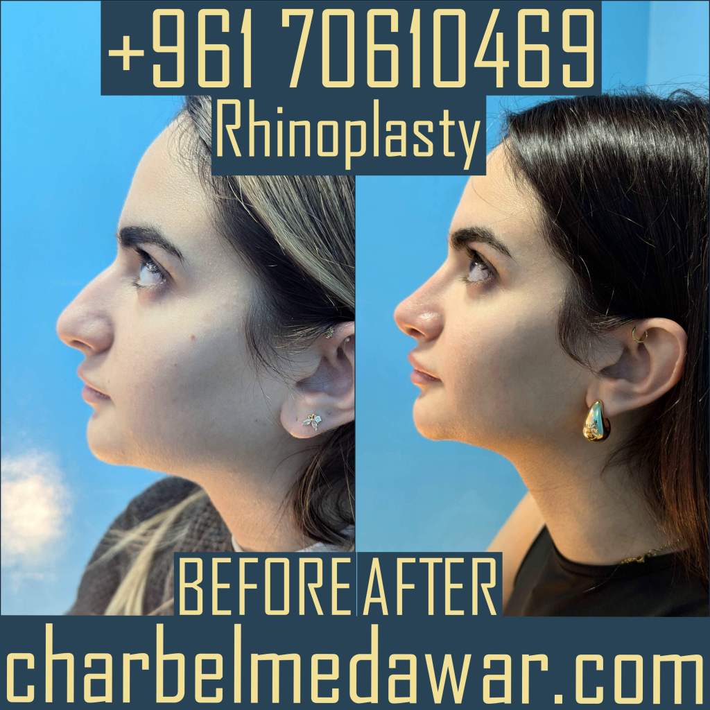 rhinoplasty expert lebanon dr charbel medawar