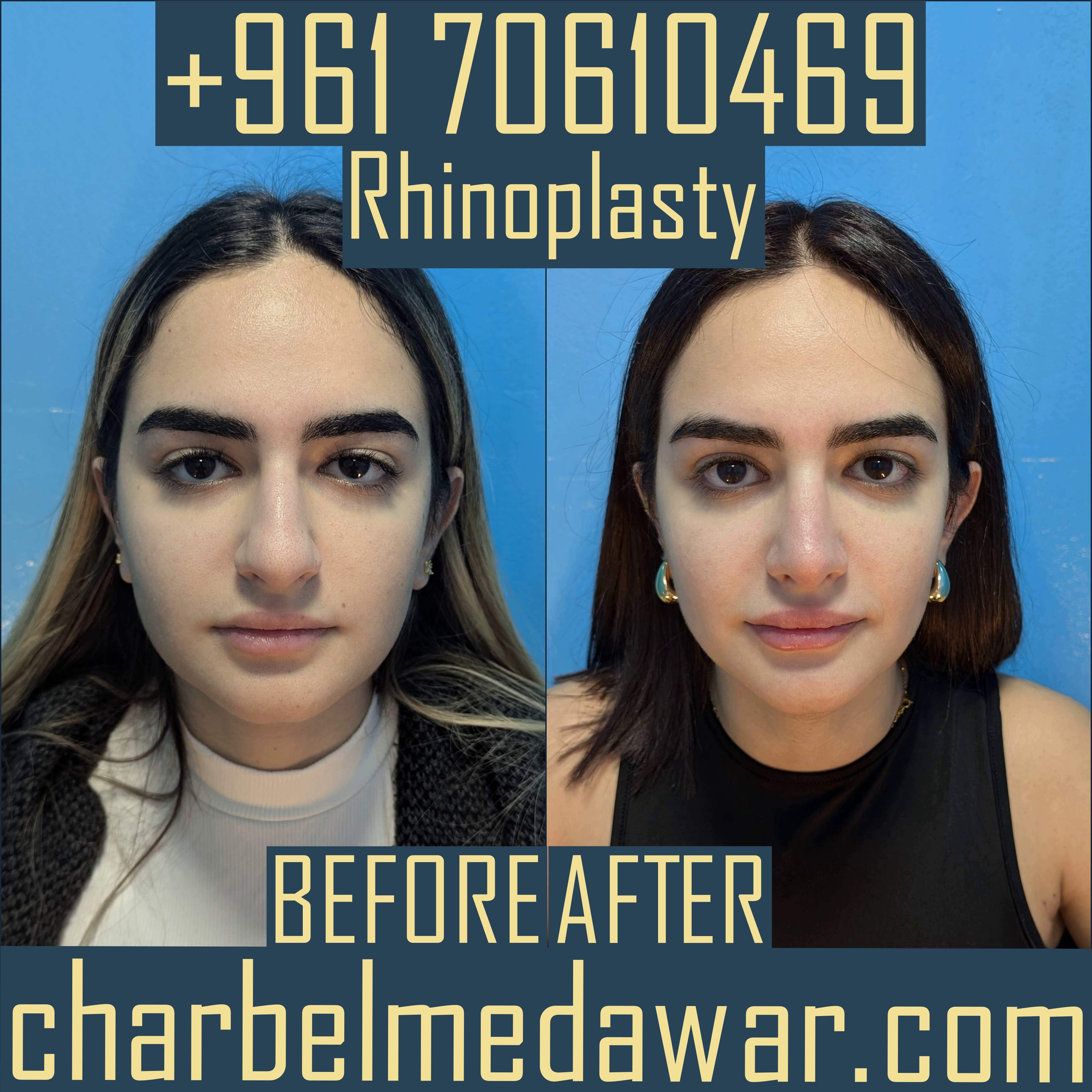rhinoplasty lebanon expert dr charbel medawar
