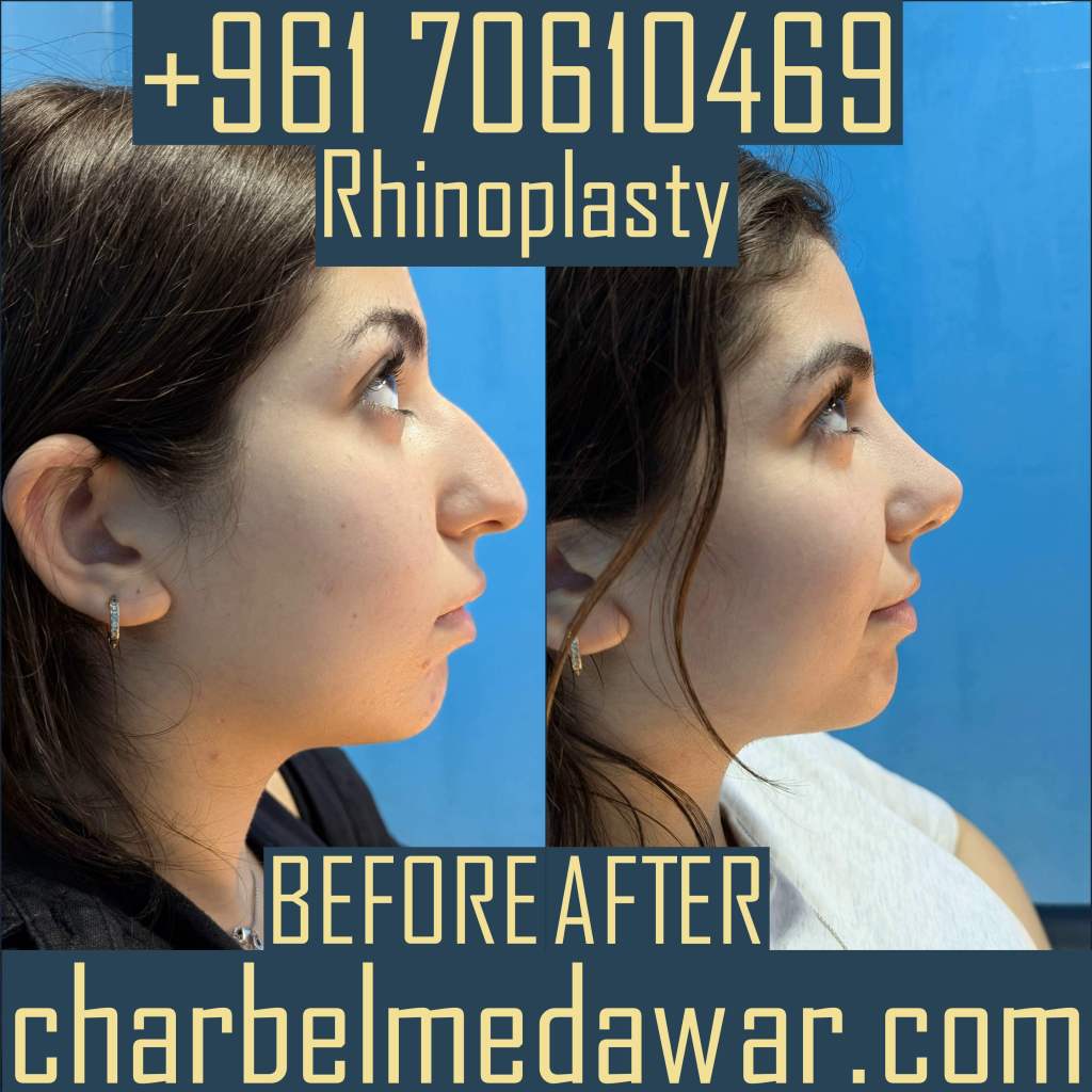 top rated best rhinoplasty surgeon in lebanon