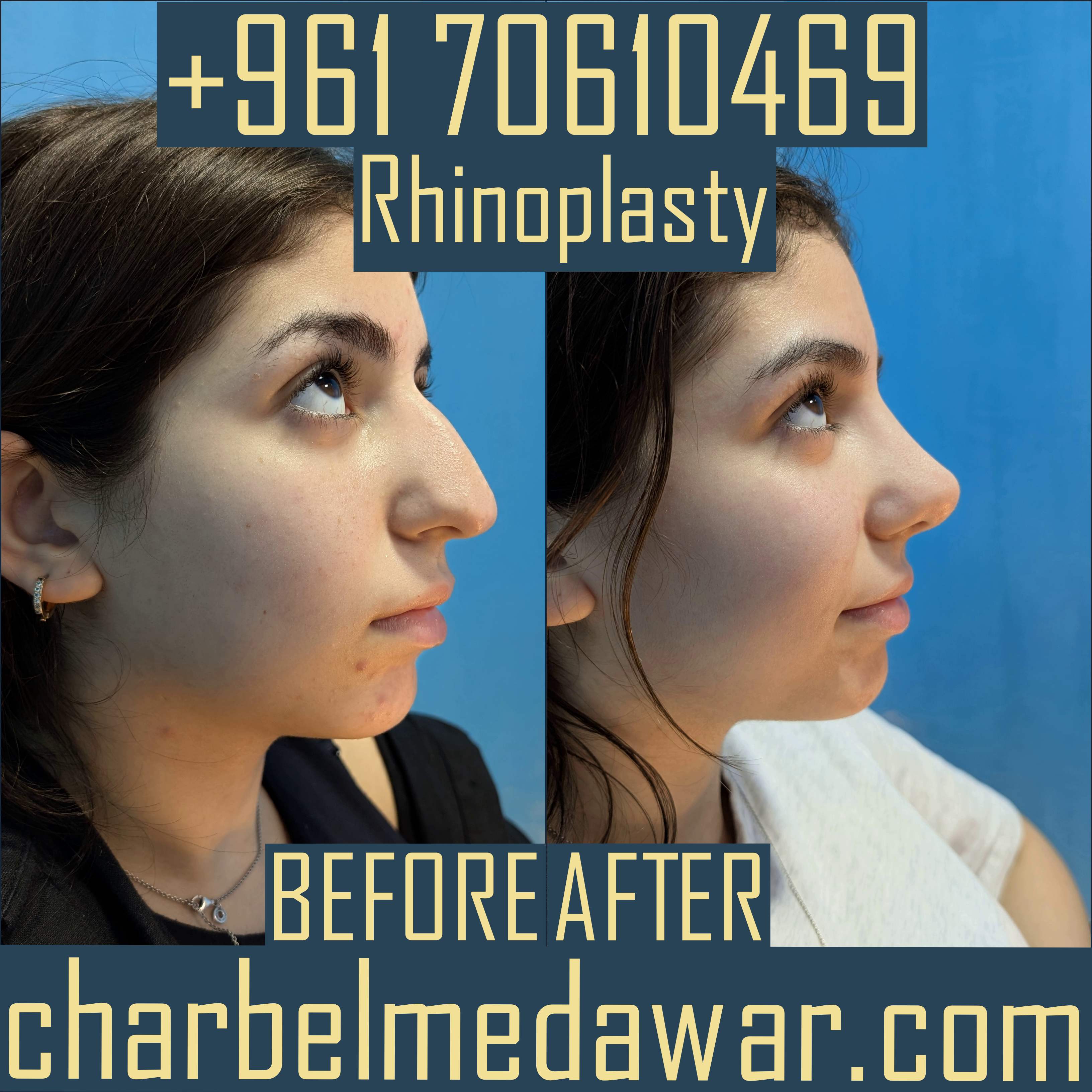 top rated rhinoplasty surgeon in lebanon
