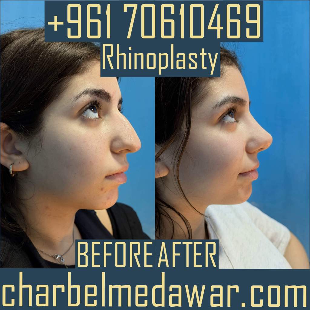 top rated rhinoplasty surgeon in lebanon
