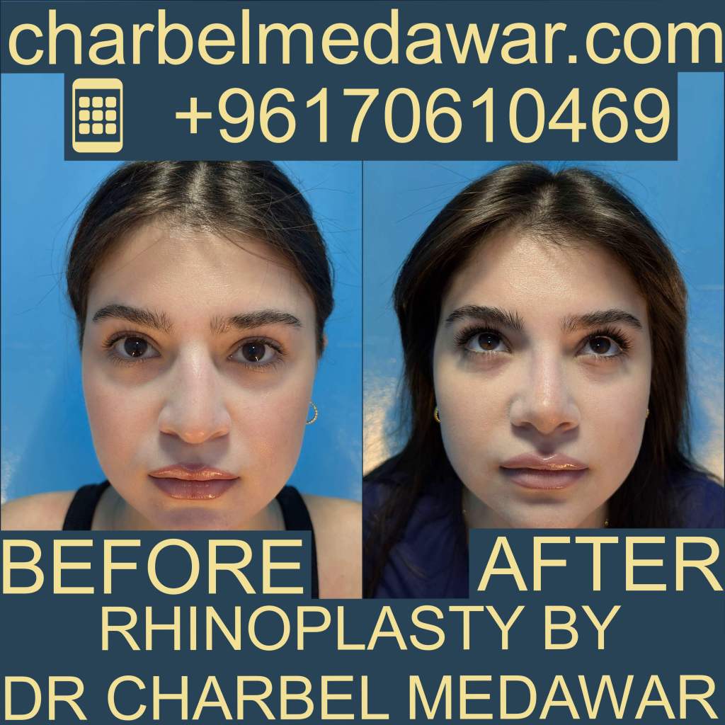 best revision rhinoplasty doctor in Lebanon dr charbel medawar