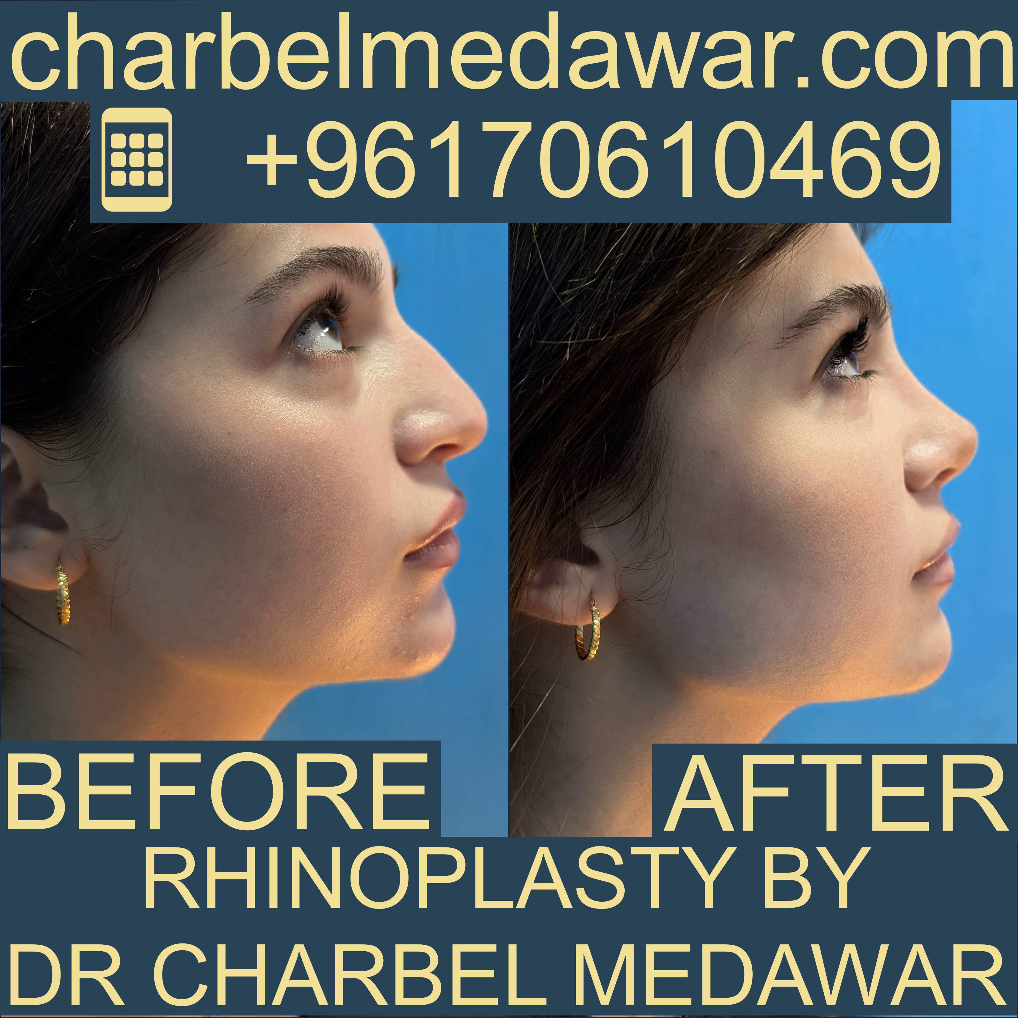 أفضل دكتور تجميل أنف شربل مدور