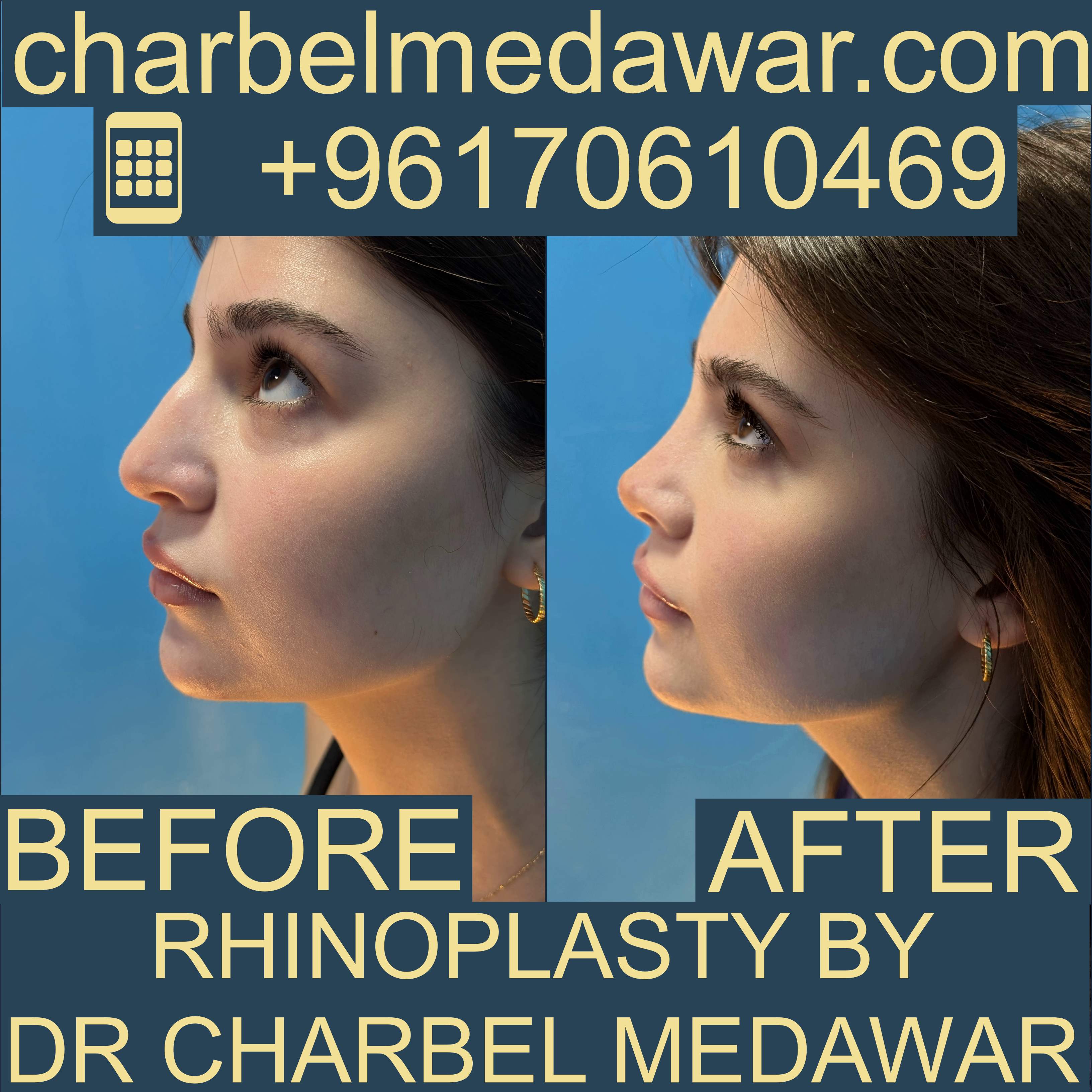 top rhinoplasty surgeons in Lebanon