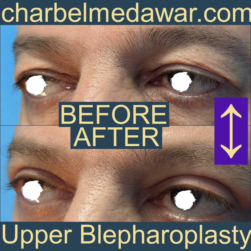 best blepharoplasty surgeon in lebanon dr charbel medawar