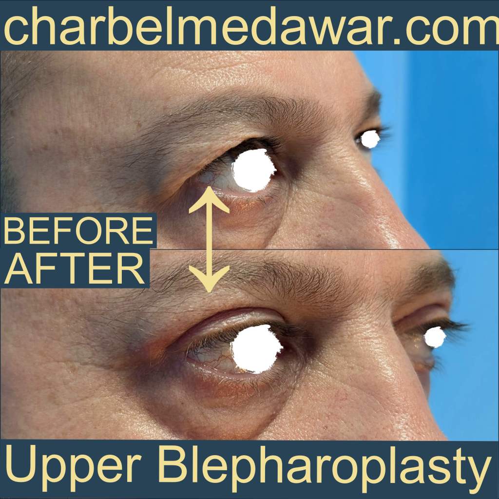 best eyelid plastic surgeon in lebanon dr charbel medawar