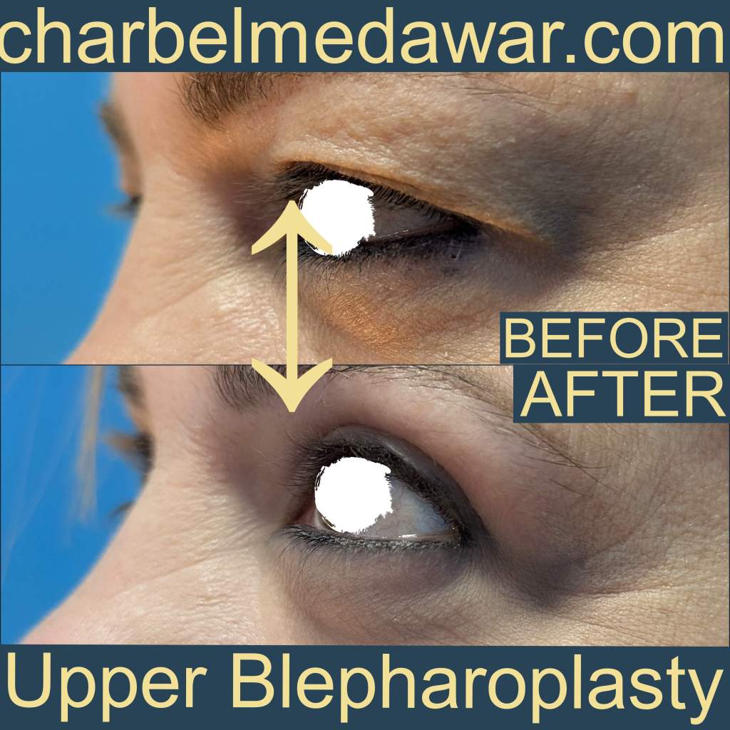 best eyelid plastic surgeon in lebanon dr charbel medawar