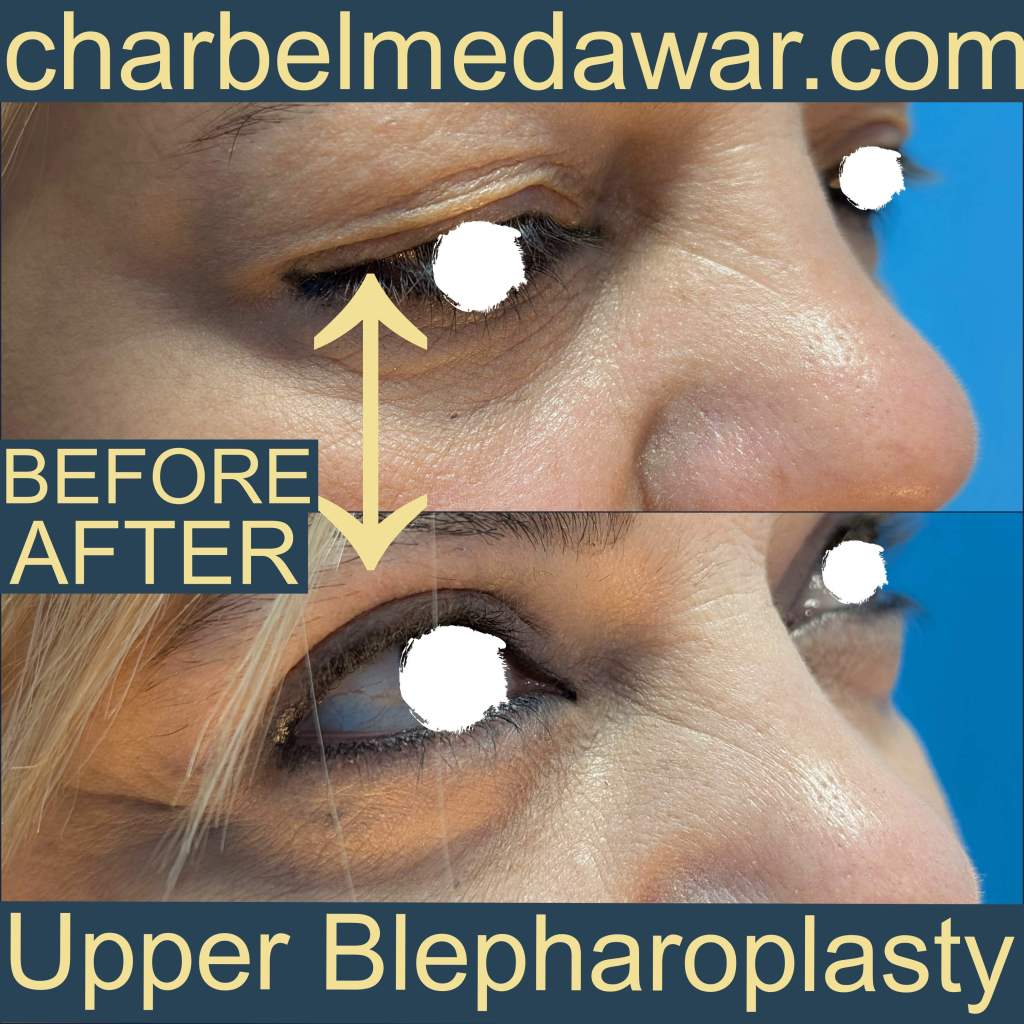 best eyelid surgeon in lebanon dr charbel medawar